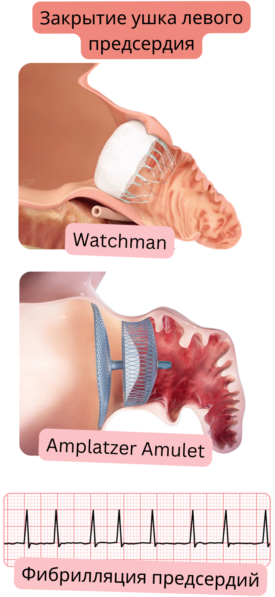 Иллюстрация, демонстрирующая закрытие ушка левого предсердия с помощью окклюзионных устройств Watchman и Amplatzer Amulet как альтернативу профилактике тромбоэмболии при фибрилляции предсердий.
