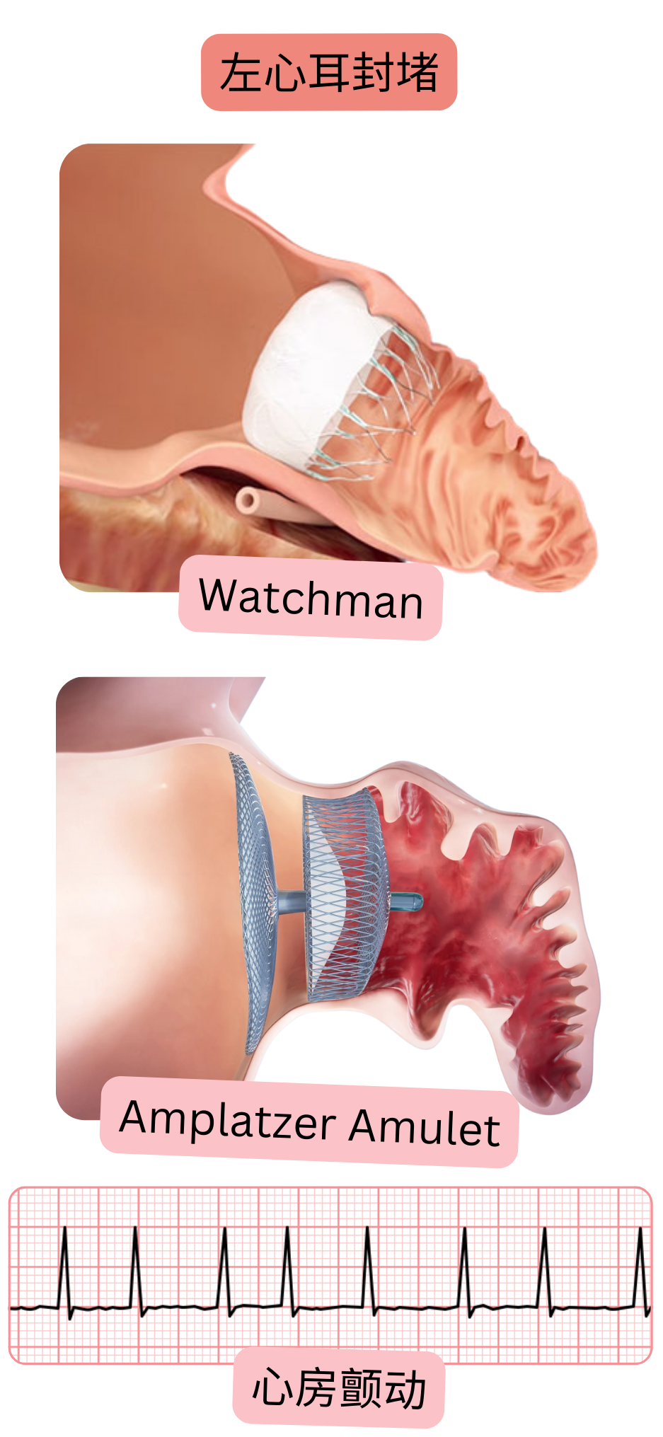示意图展示采用 Watchman 和 Amplatzer Amulet 封堵装置进行左心耳封堵，作为心房颤动患者预防血栓栓塞的替代方案。