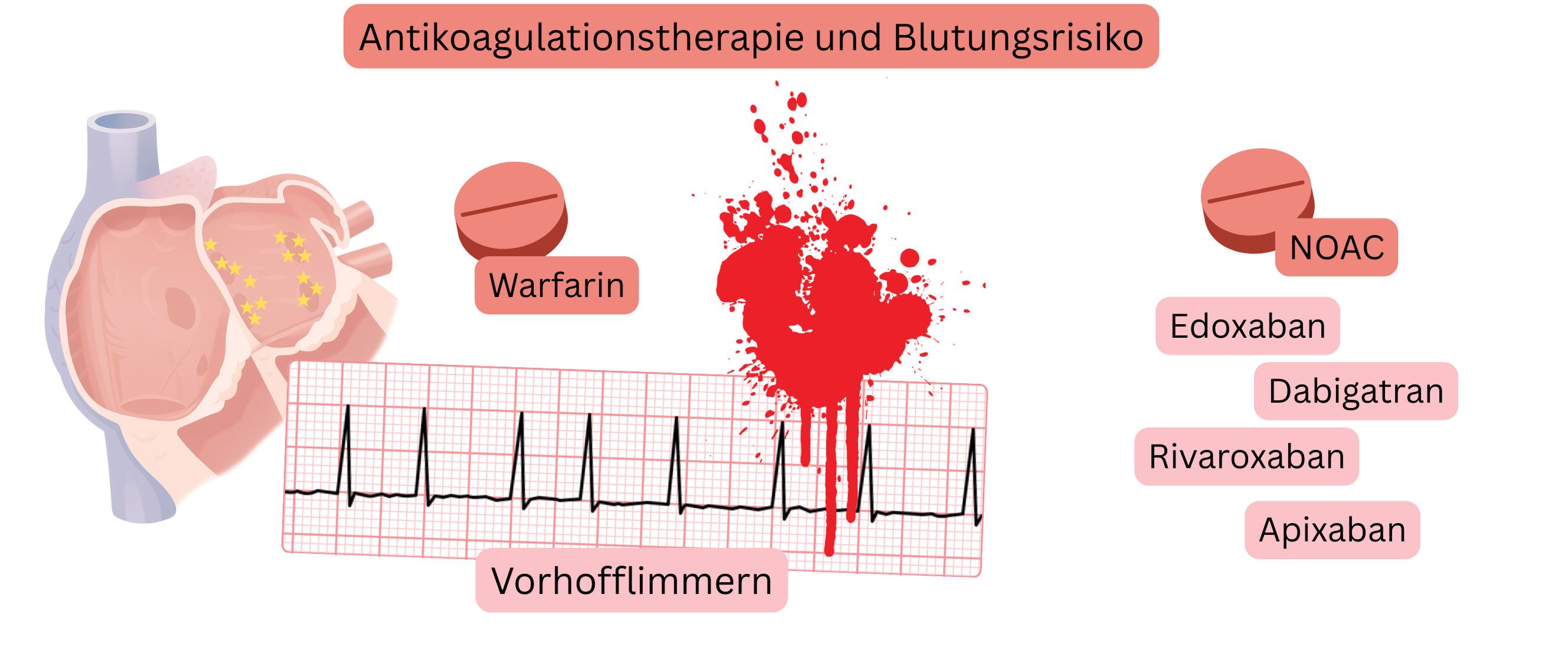Abbildung zur Darstellung der Antikoagulation bei Vorhofflimmern mit Vergleich von Warfarin und NOAK sowie visueller Darstellung des Blutungsrisikos.
