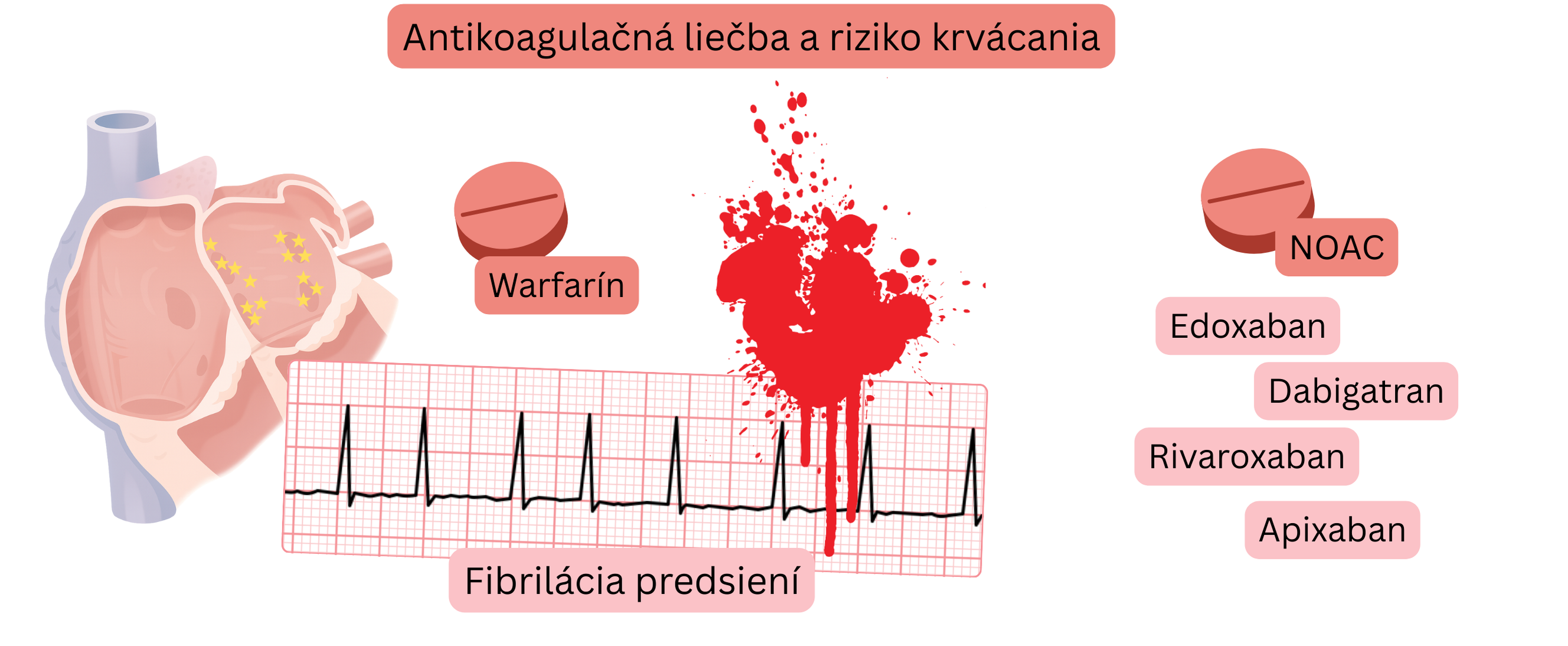 Ilustrácia znázorňujúca antikoagulačnú liečbu pri fibrilácii predsiení s porovnaním warfarínu a NOAC a s vizuálnym znázornením rizika krvácania.