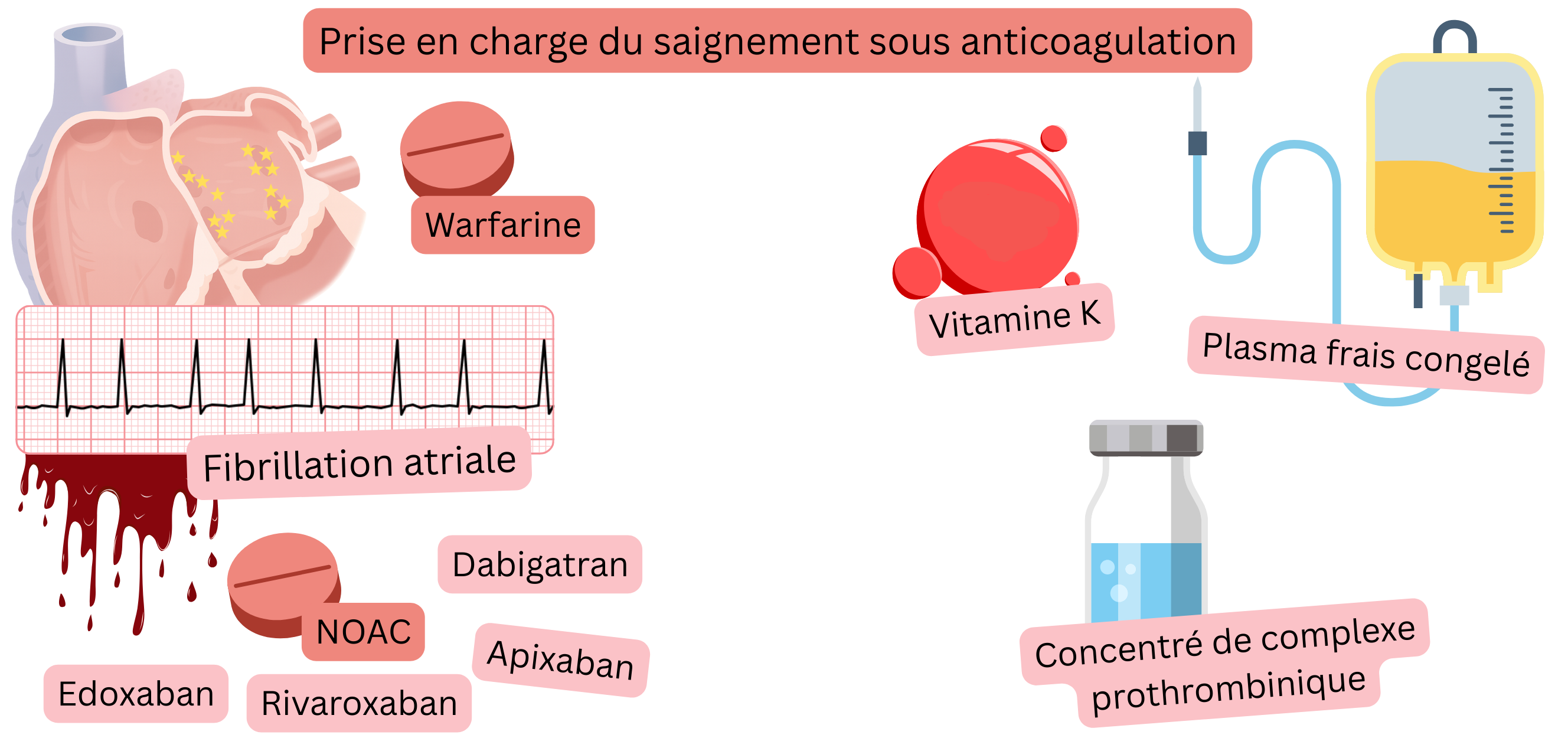 Illustration représentant le traitement anticoagulant de la fibrillation atriale, avec une comparaison entre la warfarine et les AOD et une visualisation du risque hémorragique.