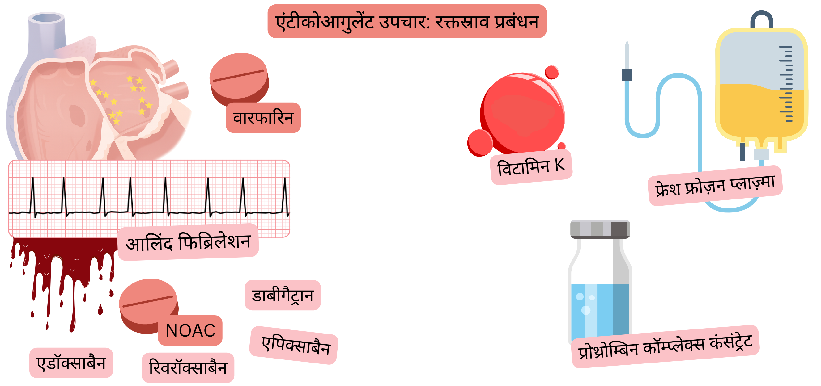 चित्र में एट्रियल फिब्रिलेशन में एंटीकोएगुलेंट उपचार को दर्शाया गया है, जिसमें वारफारिन और NOAC की तुलना तथा रक्तस्राव जोखिम का दृश्यात्मक प्रस्तुतीकरण शामिल है।