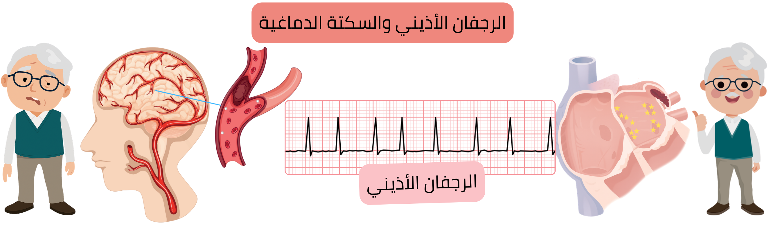 رسم توضيحي يبيّن السكتة الدماغية، بما في ذلك الشكل الإقفاري الناتج عن انسداد شريان دماغي بخثرة أو صمة، والشكل النزفي الناتج عن تمزق وعاء دموي مع نزف داخل القحف.