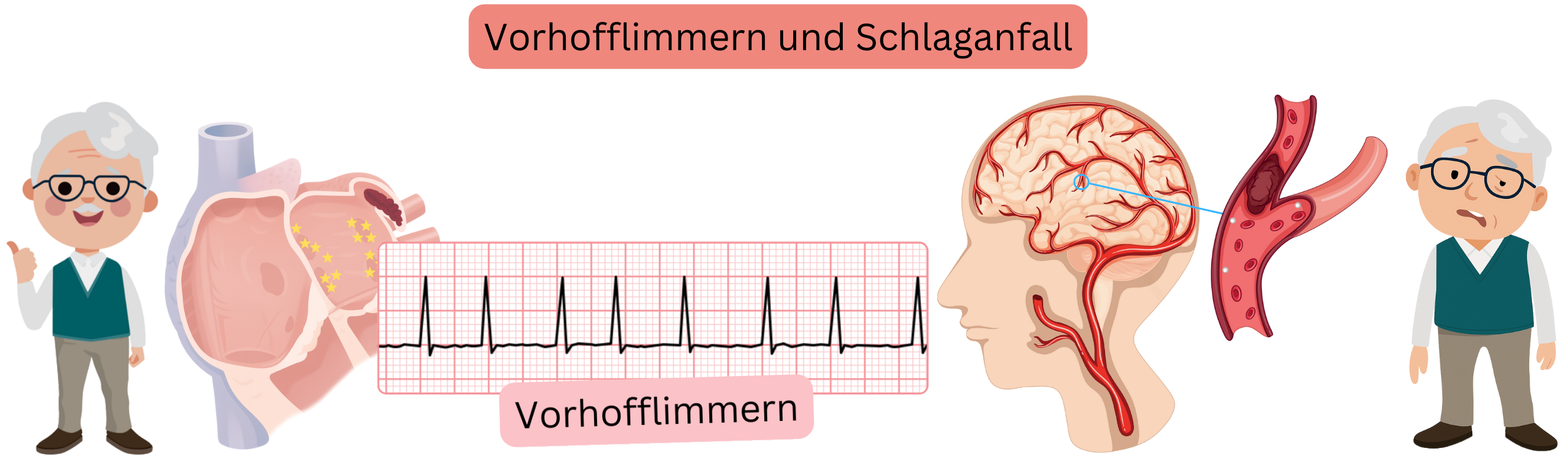 Abbildung zur Darstellung des Schlaganfalls mit ischämischer Form infolge des Verschlusses einer Hirnarterie durch Thrombus oder Embolus sowie der hämorrhagischen Form durch Gefäßruptur mit intrakranieller Blutung.
