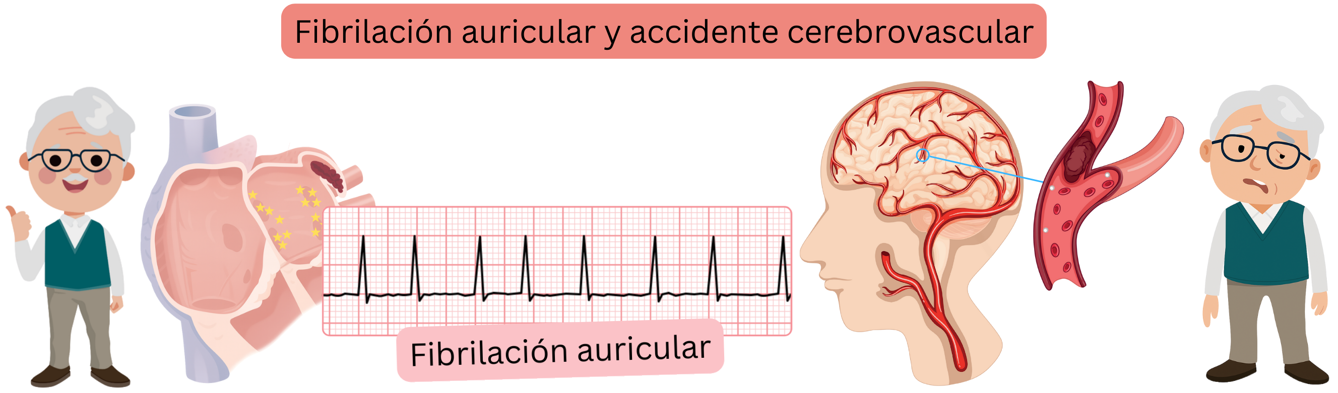 Ilustración que muestra el ictus, incluyendo la forma isquémica causada por la oclusión de una arteria cerebral por un trombo o émbolo y la forma hemorrágica causada por la rotura vascular con hemorragia intracraneal.
