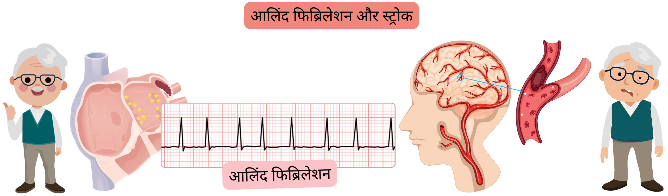 चित्र में स्ट्रोक को दर्शाया गया है, जिसमें थ्रोम्बस या एम्बोलस द्वारा मस्तिष्क धमनी के अवरोध से होने वाला इस्कीमिक स्ट्रोक और रक्त वाहिका के फटने से होने वाला इंट्राक्रैनियल रक्तस्राव युक्त हेमोरेजिक स्ट्रोक शामिल है।