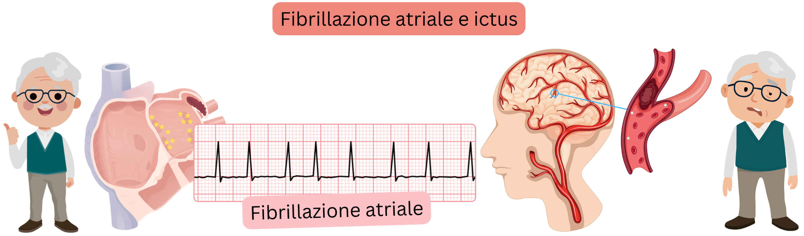 Illustrazione che mostra l’ictus, includendo la forma ischemica causata dall’occlusione di un’arteria cerebrale da trombo o embolo e la forma emorragica dovuta alla rottura vascolare con sanguinamento intracranico.