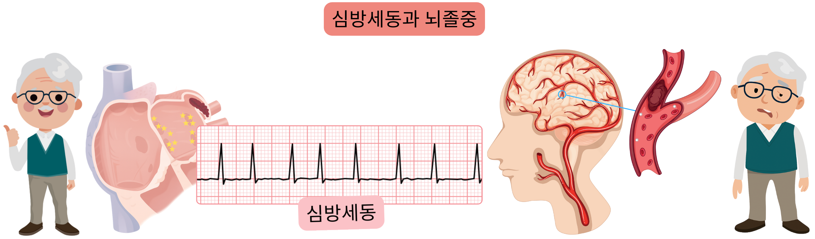 혈전 또는 색전에 의한 뇌동맥 폐쇄로 발생하는 허혈성 뇌졸중과 혈관 파열로 인한 두개내 출혈의 출혈성 뇌졸중을 포함한 뇌졸중을 보여주는 일러스트.