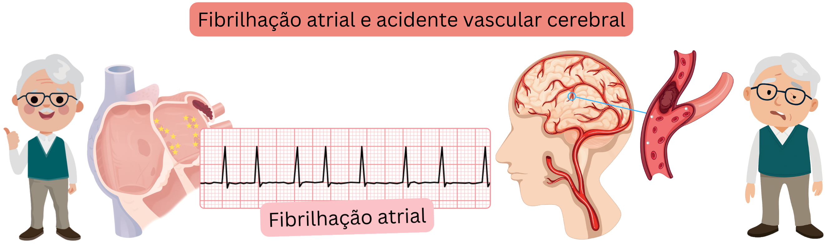 Ilustração que demonstra o acidente vascular cerebral, incluindo a forma isquémica causada pela oclusão de uma artéria cerebral por trombo ou êmbolo e a forma hemorrágica resultante da rutura vascular com hemorragia intracraniana.
