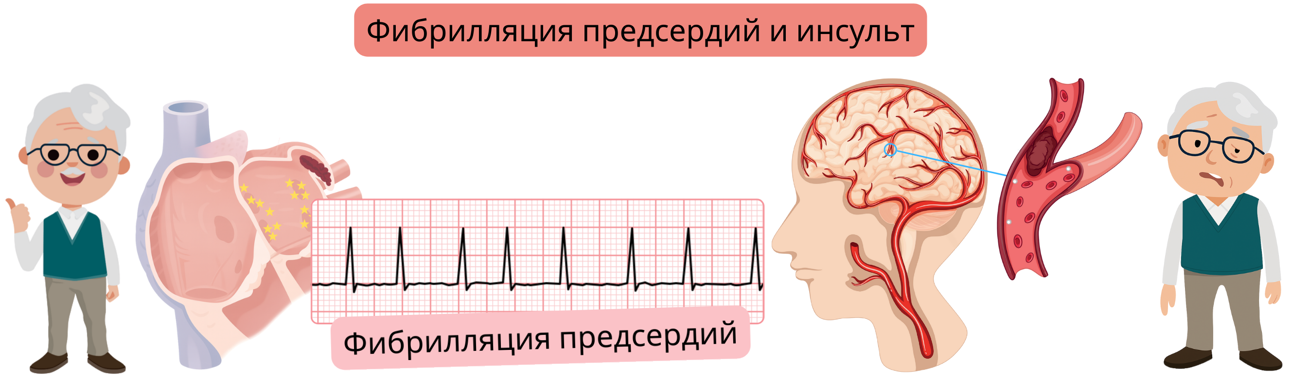 Иллюстрация, демонстрирующая инсульт, включая ишемическую форму, вызванную окклюзией мозговой артерии тромбом или эмболом, и геморрагическую форму, обусловленную разрывом сосуда с внутричерепным кровоизлиянием.