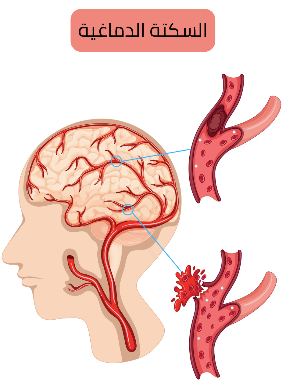رسم توضيحي يبيّن السكتة الدماغية، بما في ذلك الشكل الإقفاري الناتج عن انسداد شريان دماغي بخثرة أو صمة، والشكل النزفي الناتج عن تمزق وعاء دموي مع نزف داخل القحف.