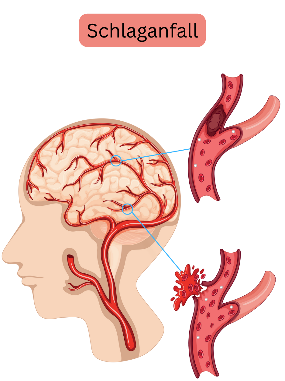 Abbildung zur Darstellung des Schlaganfalls mit ischämischer Form infolge des Verschlusses einer Hirnarterie durch Thrombus oder Embolus sowie der hämorrhagischen Form durch Gefäßruptur mit intrakranieller Blutung.