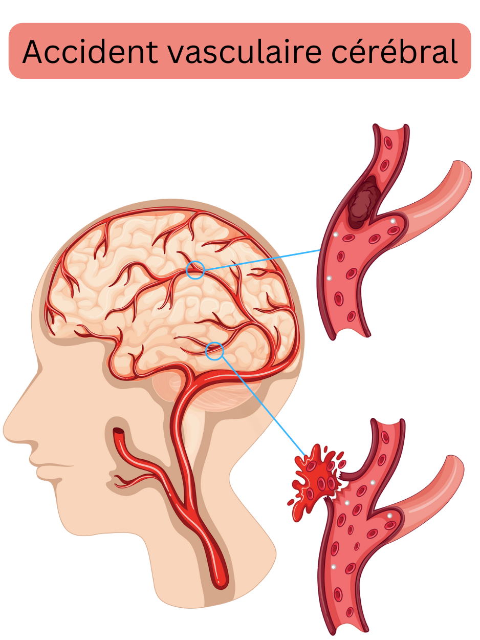 Illustration représentant l’accident vasculaire cérébral, incluant la forme ischémique due à l’occlusion d’une artère cérébrale par un thrombus ou un embole et la forme hémorragique liée à la rupture d’un vaisseau avec hémorragie intracrânienne.