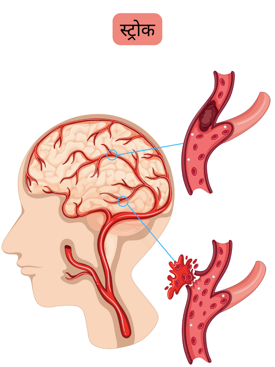 चित्र में स्ट्रोक को दर्शाया गया है, जिसमें थ्रोम्बस या एम्बोलस द्वारा मस्तिष्क धमनी के अवरोध से होने वाला इस्कीमिक स्ट्रोक और रक्त वाहिका के फटने से होने वाला इंट्राक्रैनियल रक्तस्राव युक्त हेमोरेजिक स्ट्रोक शामिल है।