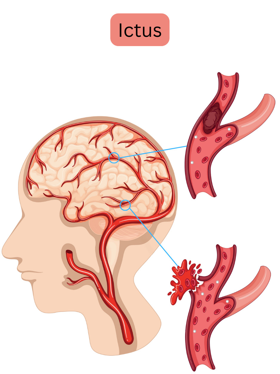 Illustrazione che mostra l’ictus, includendo la forma ischemica causata dall’occlusione di un’arteria cerebrale da trombo o embolo e la forma emorragica dovuta alla rottura vascolare con sanguinamento intracranico.