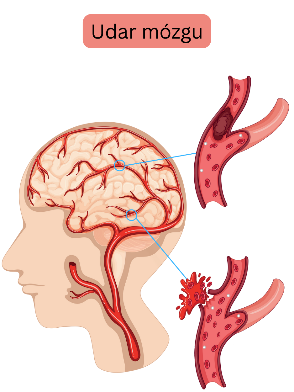 Ilustracja przedstawiająca udar mózgu, w tym postać niedokrwienną spowodowaną zamknięciem tętnicy mózgowej przez zakrzep lub zator oraz postać krwotoczną wynikającą z pęknięcia naczynia z krwawieniem wewnątrzczaszkowym.