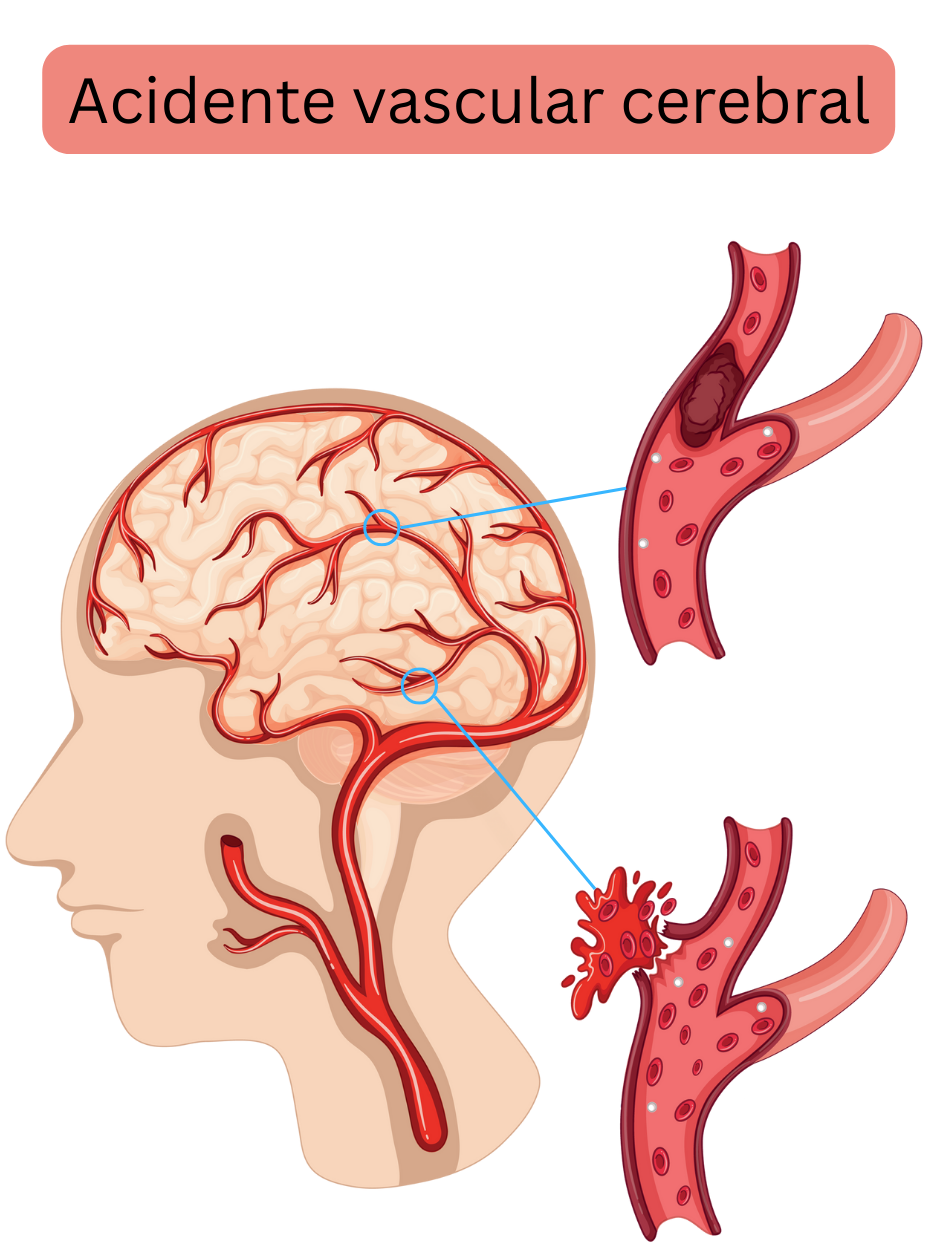 Ilustração que demonstra o acidente vascular cerebral, incluindo a forma isquémica causada pela oclusão de uma artéria cerebral por trombo ou êmbolo e a forma hemorrágica resultante da rutura vascular com hemorragia intracraniana.