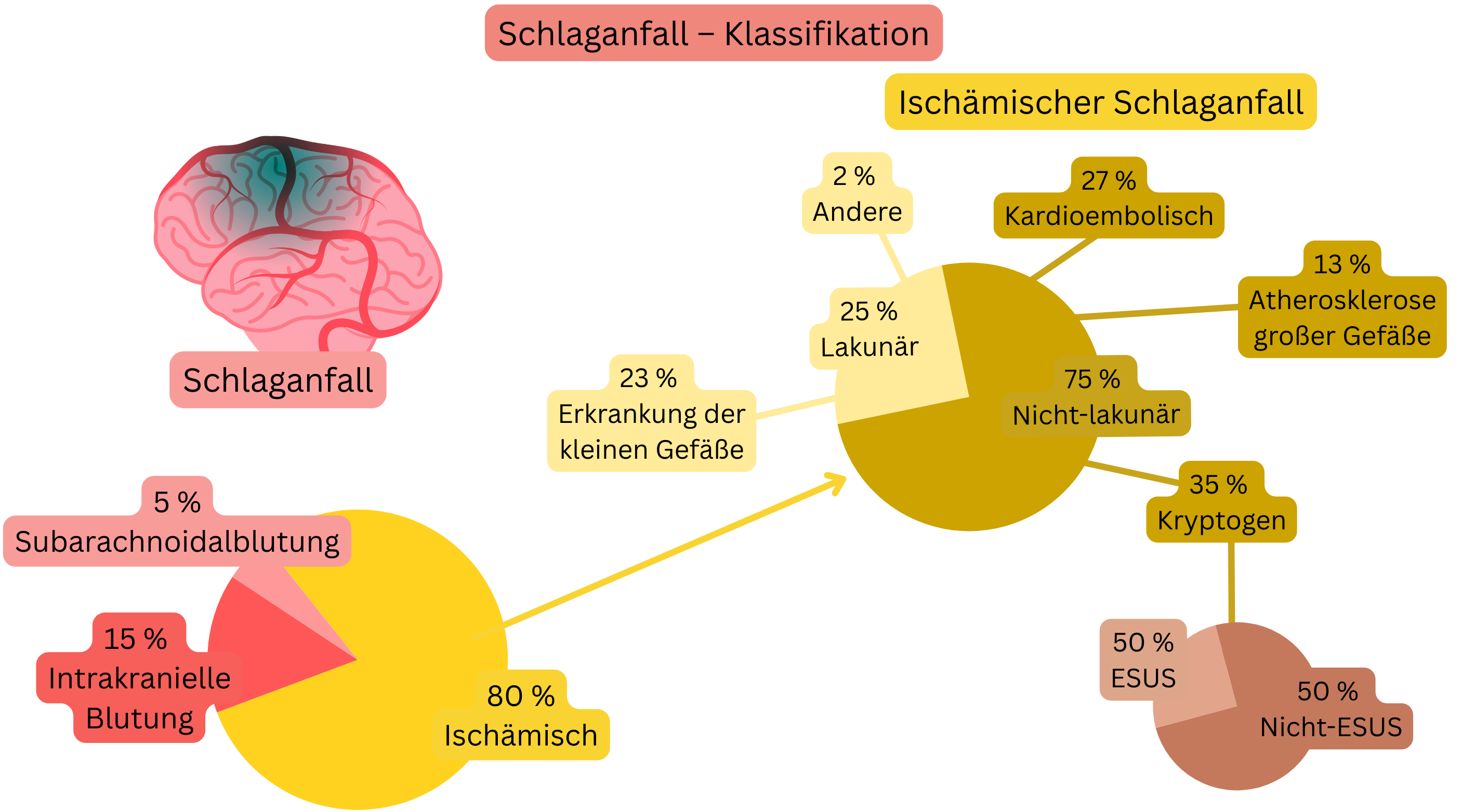 Infografik zur Einteilung des Schlaganfalls in ischämische und hämorrhagische Formen mit detaillierter mechanistischer Klassifikation des ischämischen Schlaganfalls, einschließlich lakunär, kardioembolisch, Atherosklerose großer Gefäße, kryptogen und ESUS.