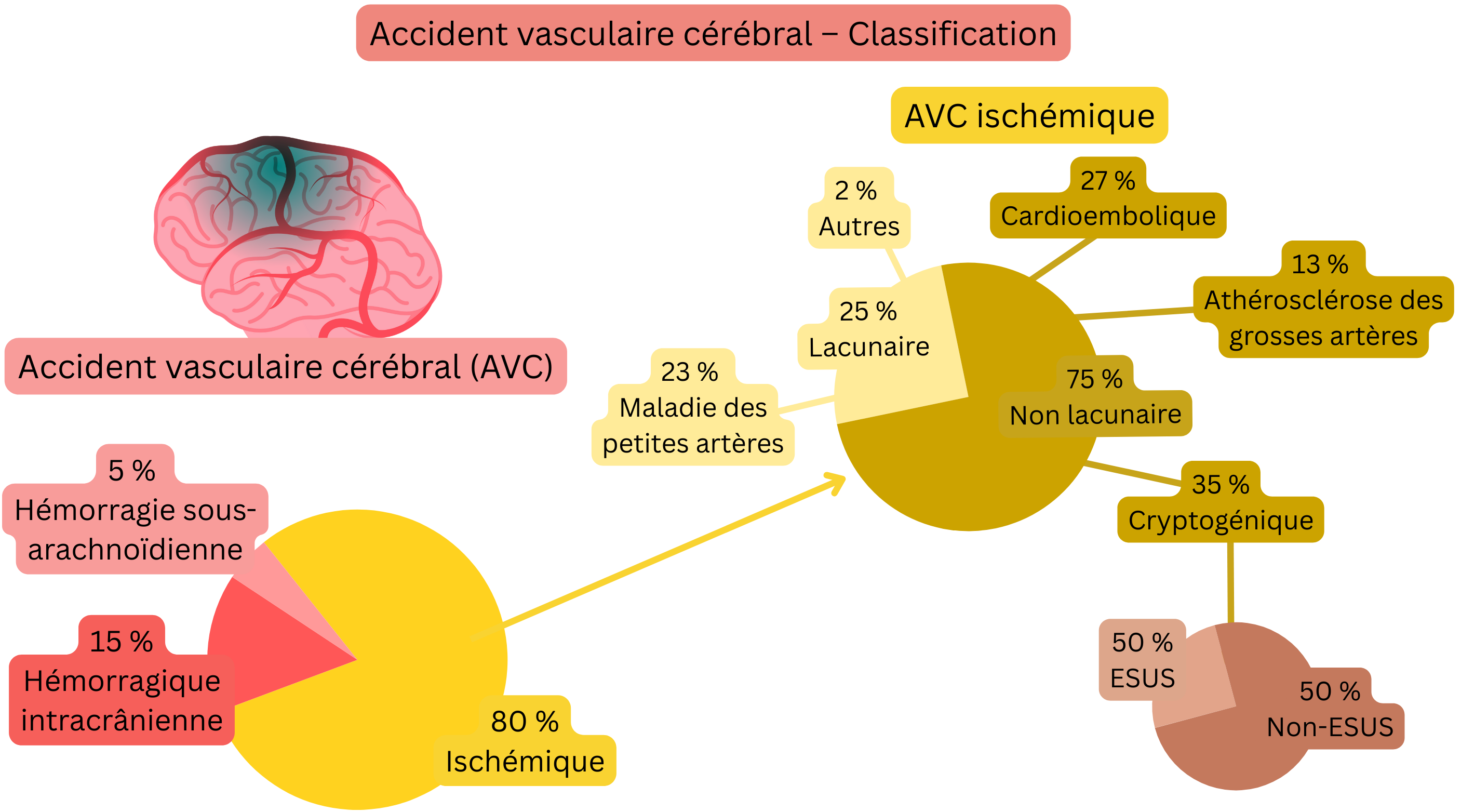 Infographie illustrant la répartition de l’accident vasculaire cérébral en formes ischémique et hémorragique, avec une classification détaillée de l’AVC ischémique selon le mécanisme, incluant lacunaire, cardioembolique, athérosclérose des grosses artères, cryptogénique et ESUS.