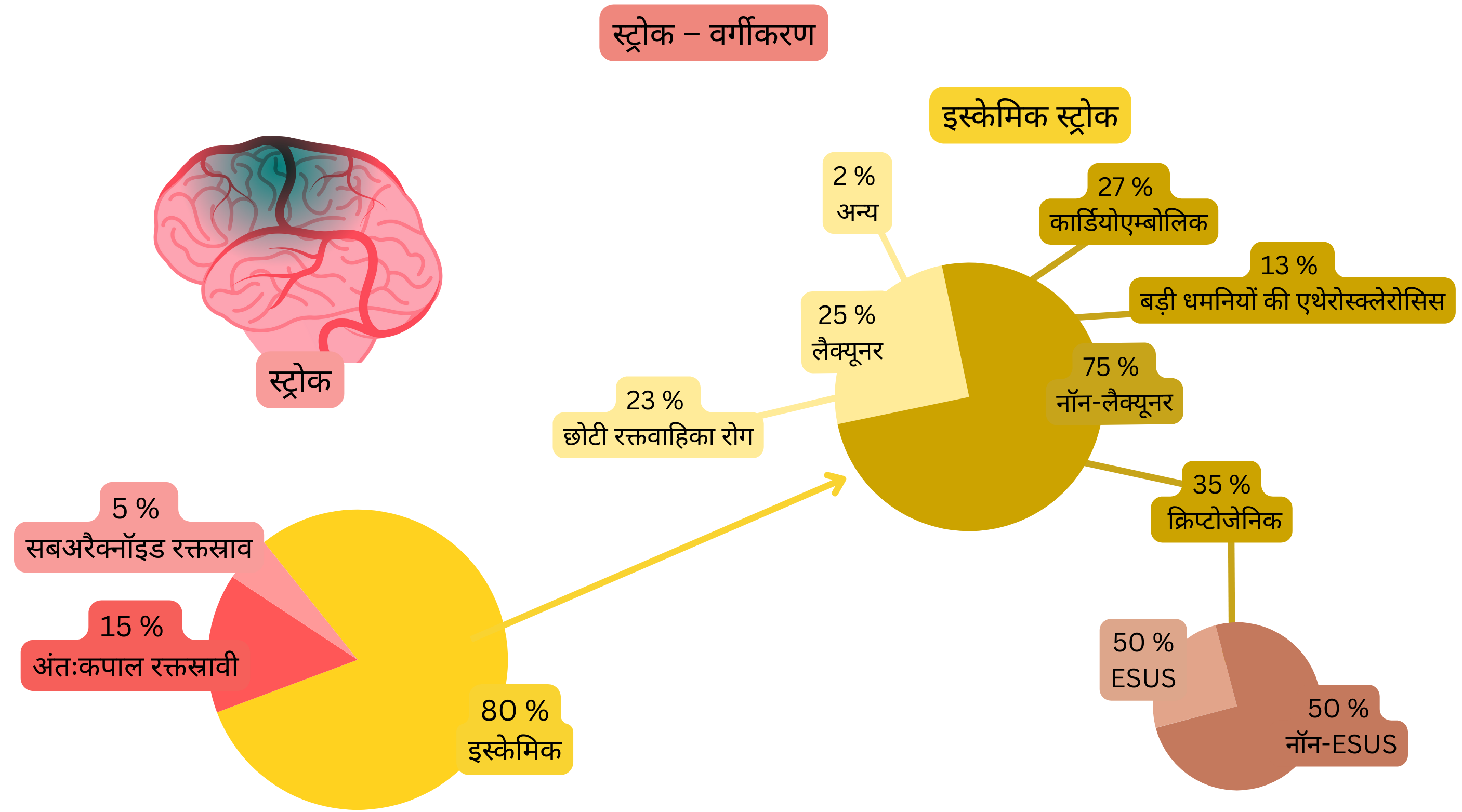 इन्फोग्राफिक में स्ट्रोक को इस्कीमिक और हेमोरेजिक प्रकारों में विभाजित किया गया है तथा इस्कीमिक स्ट्रोक का तंत्र-आधारित विस्तृत वर्गीकरण दर्शाया गया है, जिसमें लैकिनर, कार्डियोएम्बोलिक, बड़ी धमनियों की एथेरोस्क्लेरोसिस, क्रिप्टोजेनिक स्ट्रोक और ESUS शामिल हैं।