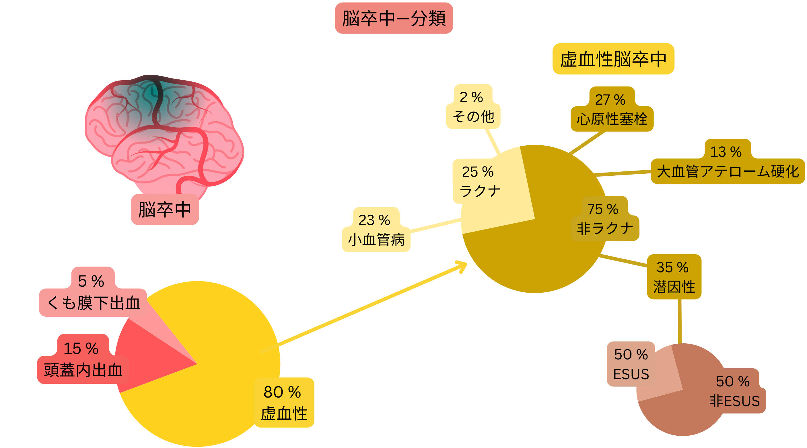 脳卒中を虚血性と出血性に分類し、虚血性脳卒中を発症機序別に、ラクナ梗塞、心原性塞栓、大血管アテローム硬化、原因不明（cryptogenic）およびESUSに詳細分類したインフォグラフィック。