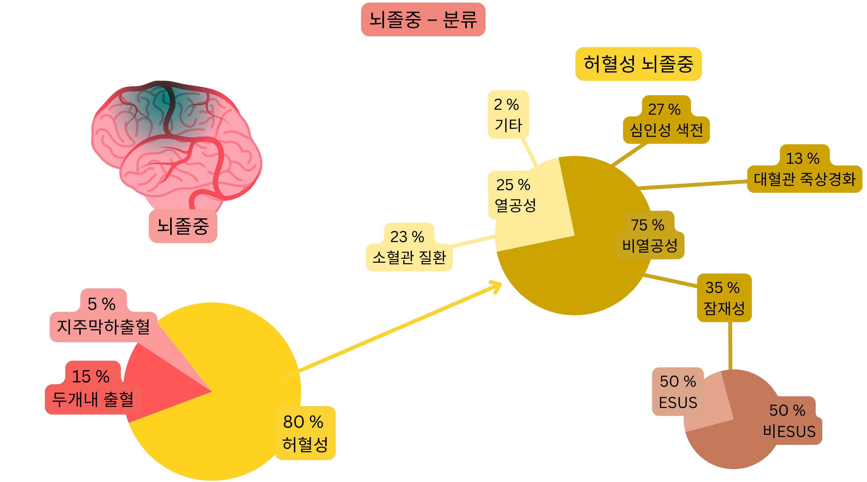 뇌졸중을 허혈성과 출혈성으로 구분하고, 허혈성 뇌졸중을 발생 기전에 따라 열공성, 심인성 색전, 대혈관 죽상경화증, 잠재성(원인불명) 뇌졸중 및 ESUS로 상세 분류한 인포그래픽.