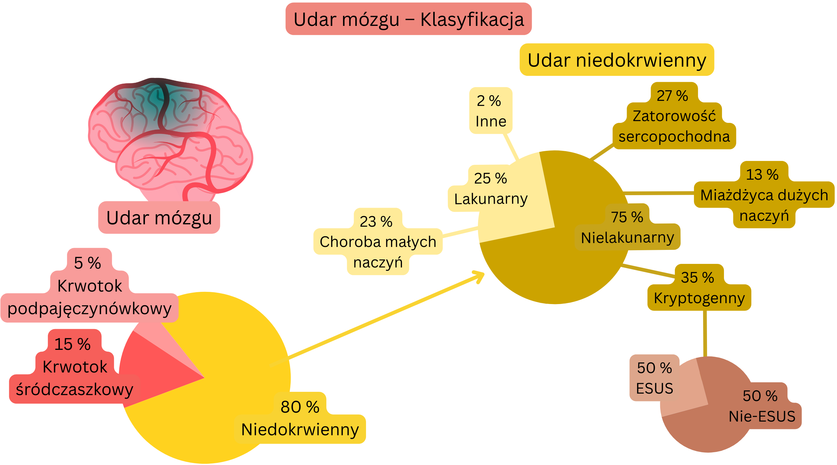 Infografika przedstawiająca podział udaru mózgu na postać niedokrwienną i krwotoczną z dokładną klasyfikacją udaru niedokrwiennego według mechanizmu powstania, w tym lakunarnego, kardioembolijnego, miażdżycy dużych naczyń, kryptogennego oraz ESUS.