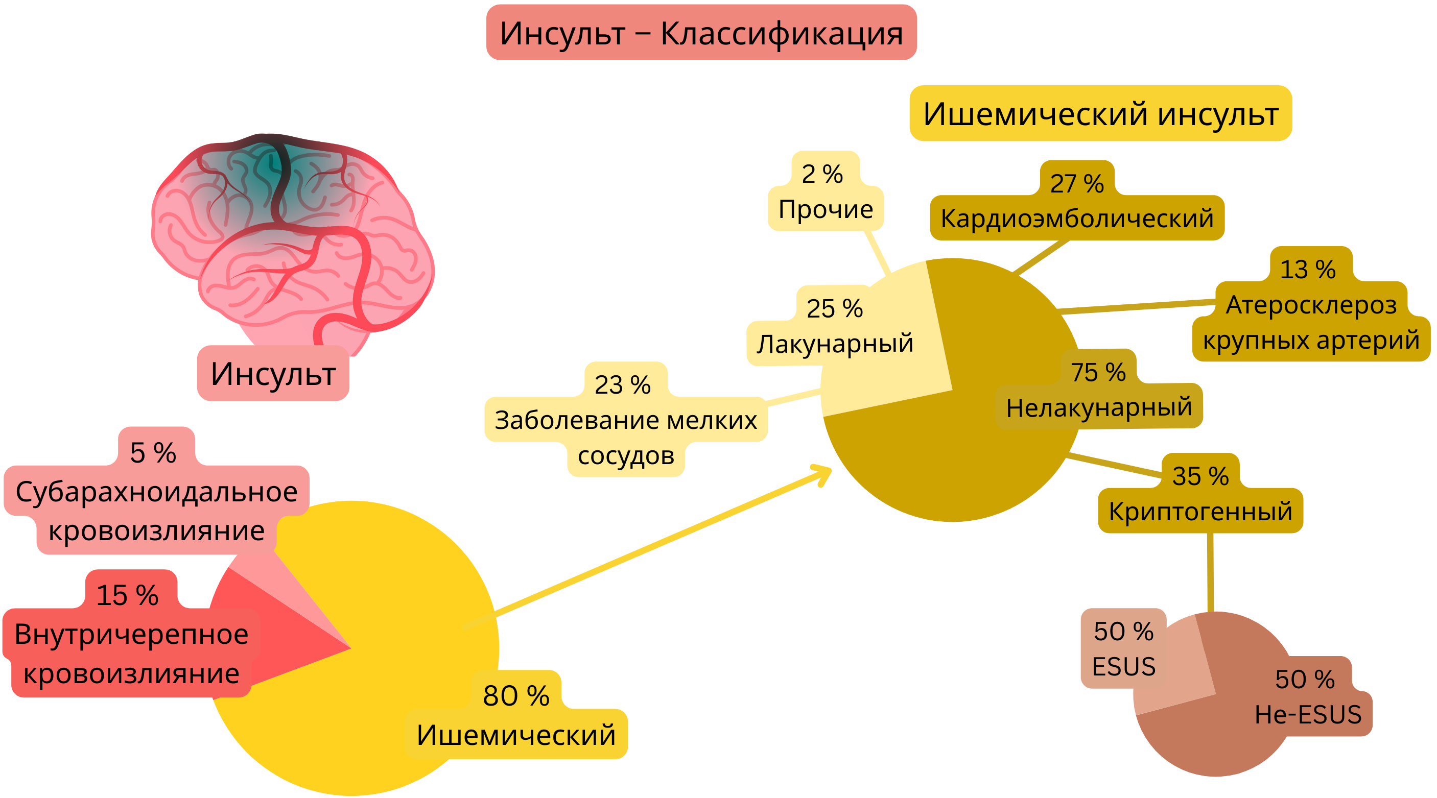 Инфографика, демонстрирующая разделение инсульта на ишемический и геморрагический типы с подробной классификацией ишемического инсульта по механизму, включая лакунарный, кардиоэмболический, атеросклероз крупных артерий, криптогенный инсульт и ESUS.