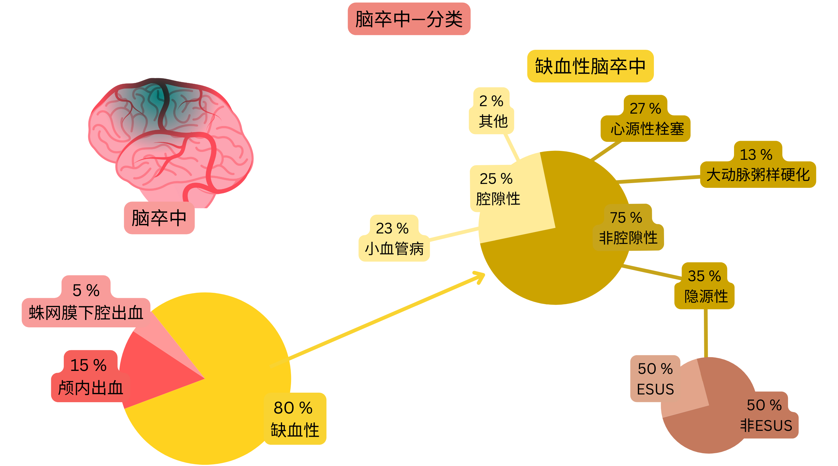 信息图展示脑卒中分为缺血性和出血性，并按发病机制对缺血性卒中进行详细分类，包括腔隙性、心源性栓塞、大动脉粥样硬化、隐源性卒中及ESUS。