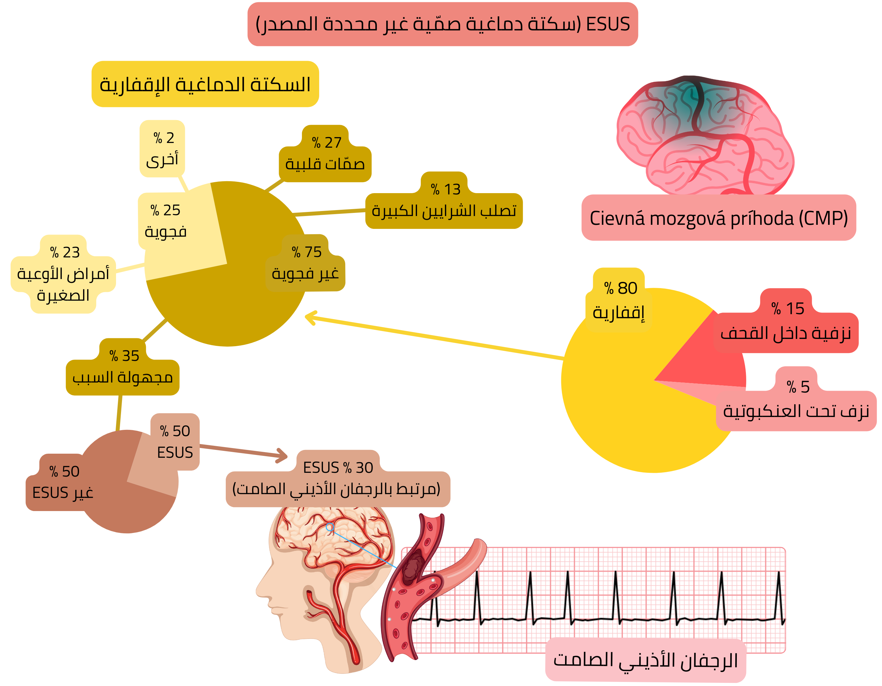 إنفوجرافيك يوضح مفهوم ESUS ضمن السكتة الدماغية الإقفارية، مع إبراز نسبة الحالات مجهولة السبب وعلاقتها بالرجفان الأذيني الصامت كمصدر محتمل للصمّات القلبية.
