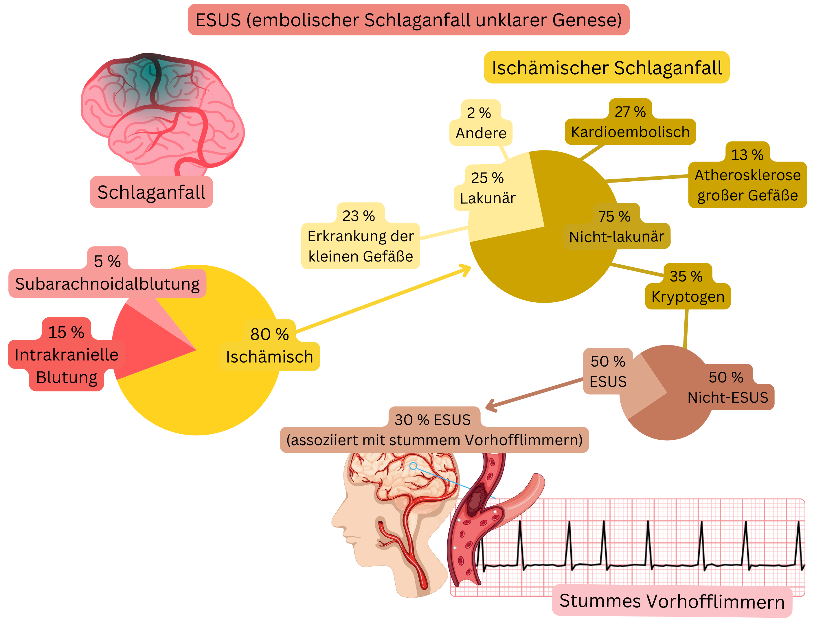 Infografik zur Darstellung des ESUS-Konzepts beim ischämischen Schlaganfall mit Hervorhebung des Anteils kryptogener Ereignisse und des Zusammenhangs mit stummer Vorhofflimmern als möglicher kardioembolischer Quelle.
