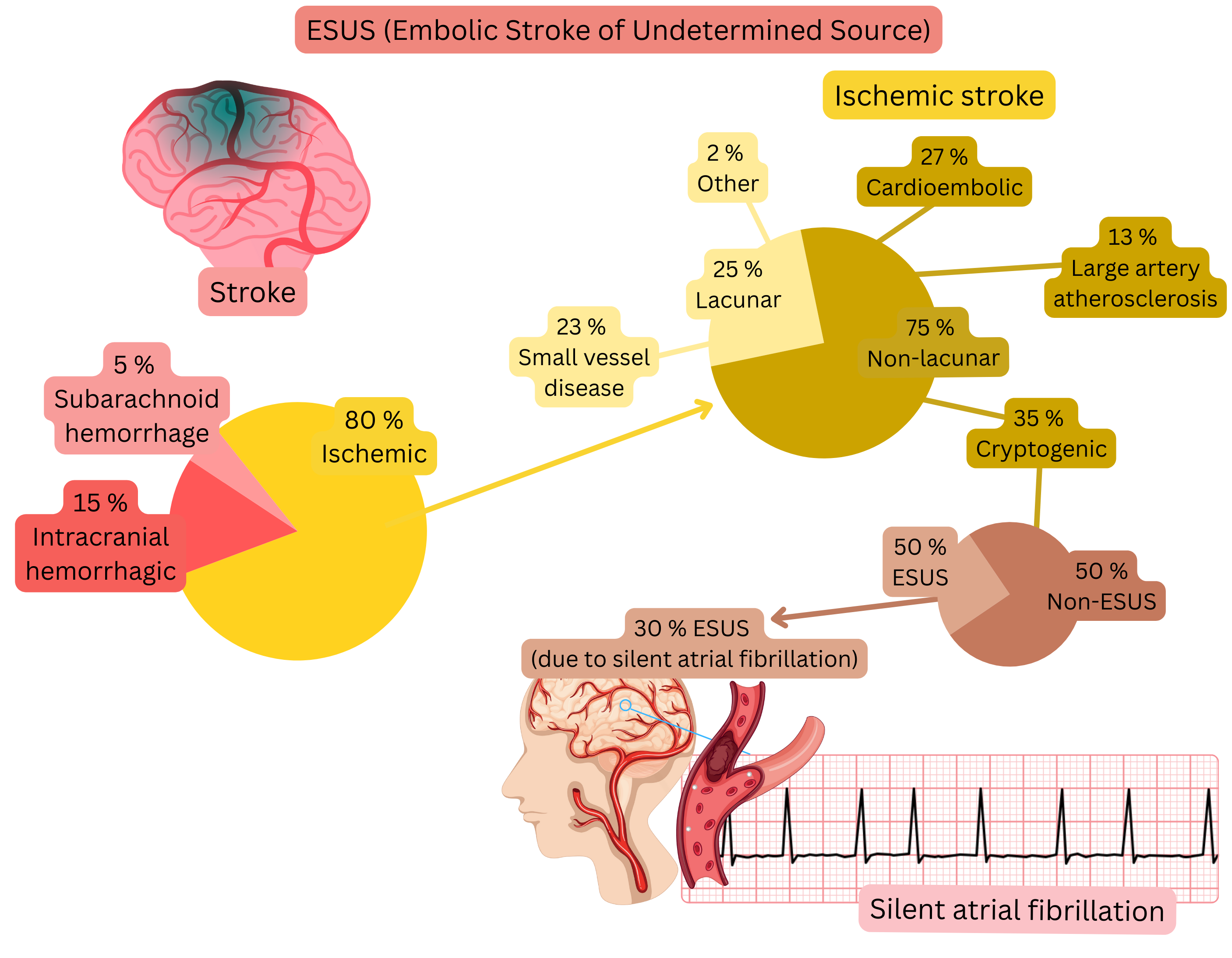 Infographic illustrating the ESUS concept within ischemic stroke, highlighting the proportion of cryptogenic events and the relationship to silent atrial fibrillation as a potential cardioembolic source.