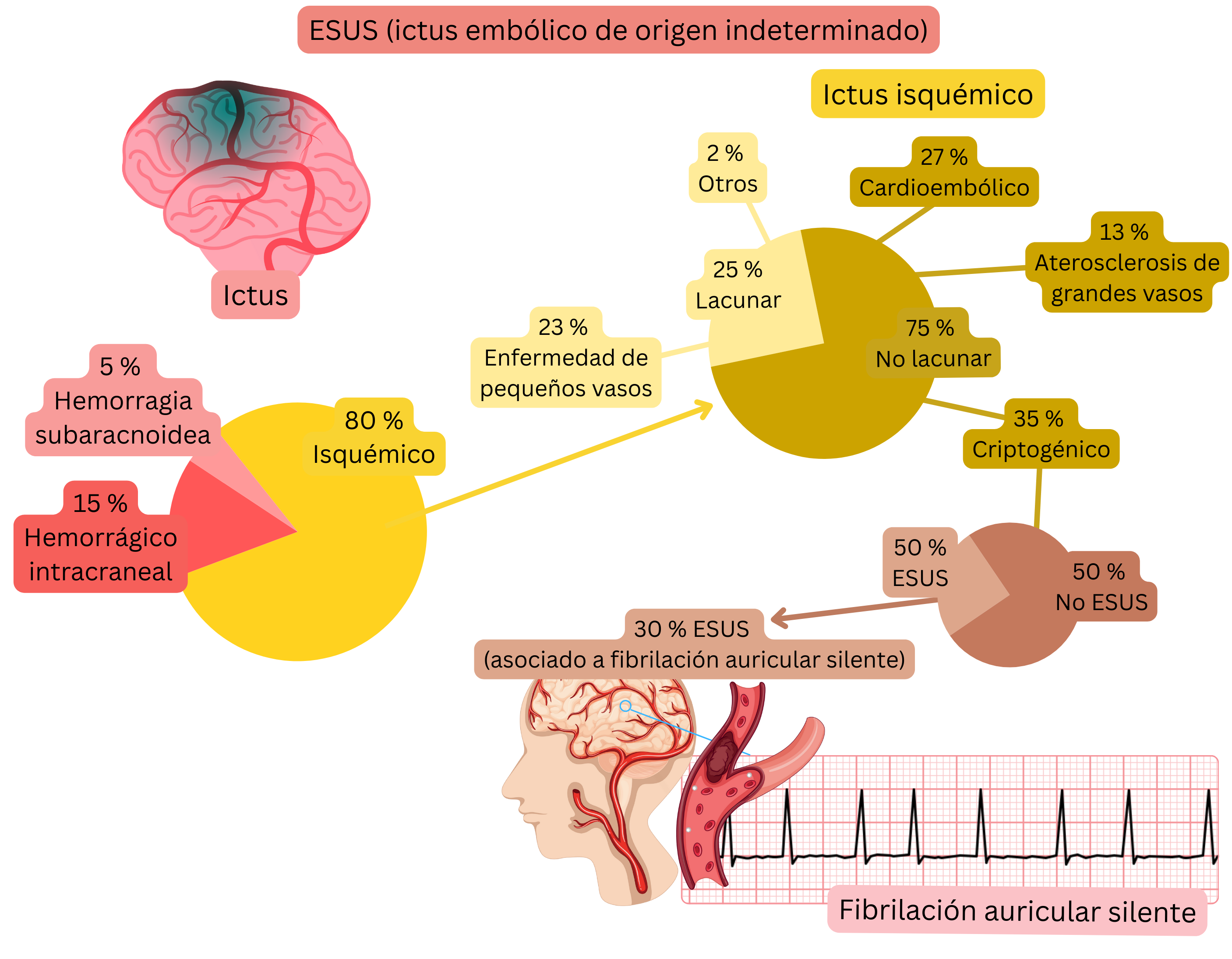 Infografía que muestra el concepto de ESUS en el ictus isquémico, destacando la proporción de eventos criptogénicos y su relación con la fibrilación auricular silenciosa como posible fuente cardioembólica.
