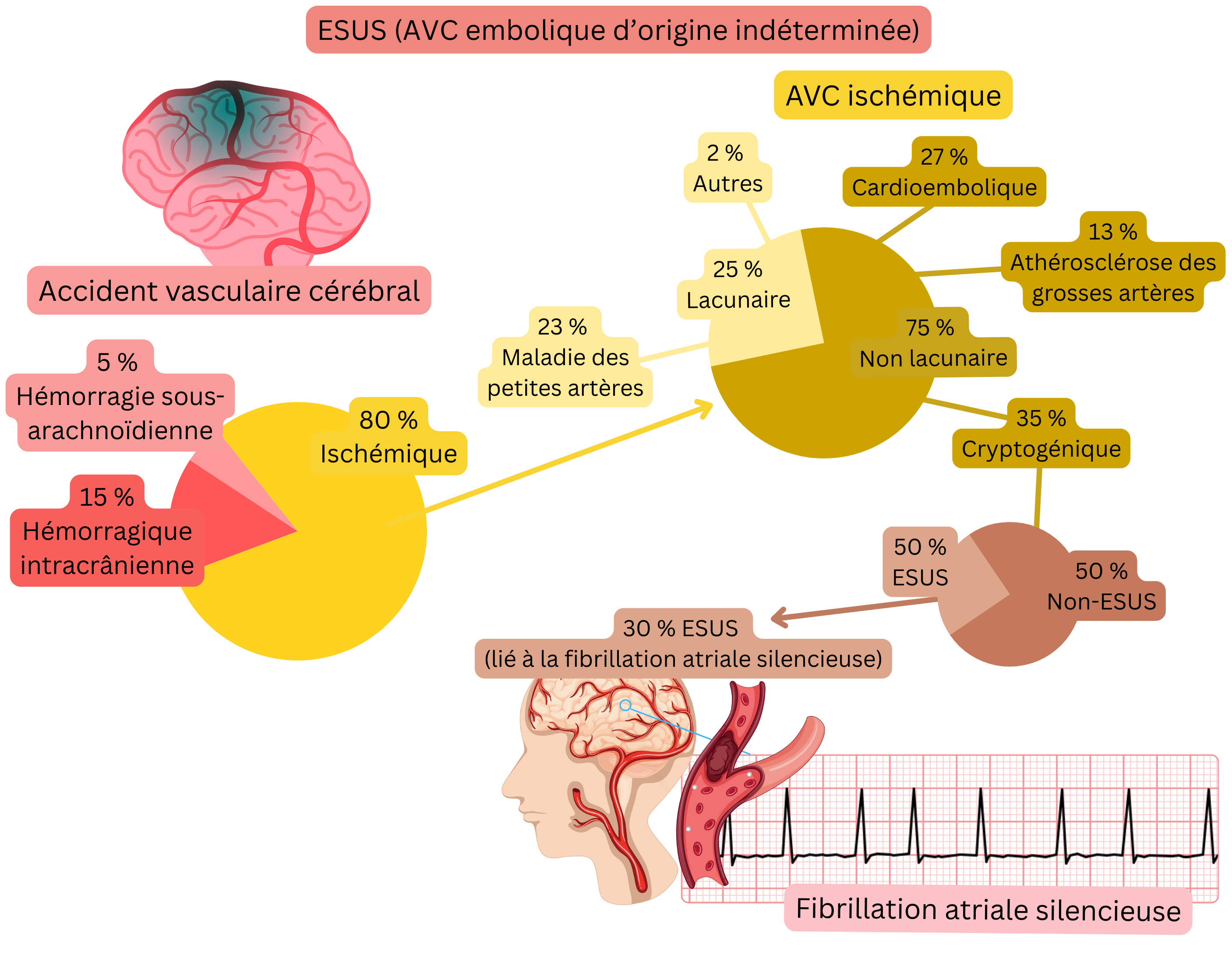 Infographie illustrant le concept d’ESUS dans l’AVC ischémique, mettant en évidence la proportion d’événements cryptogéniques et le lien avec la fibrillation atriale silencieuse comme source cardioembolique potentielle.