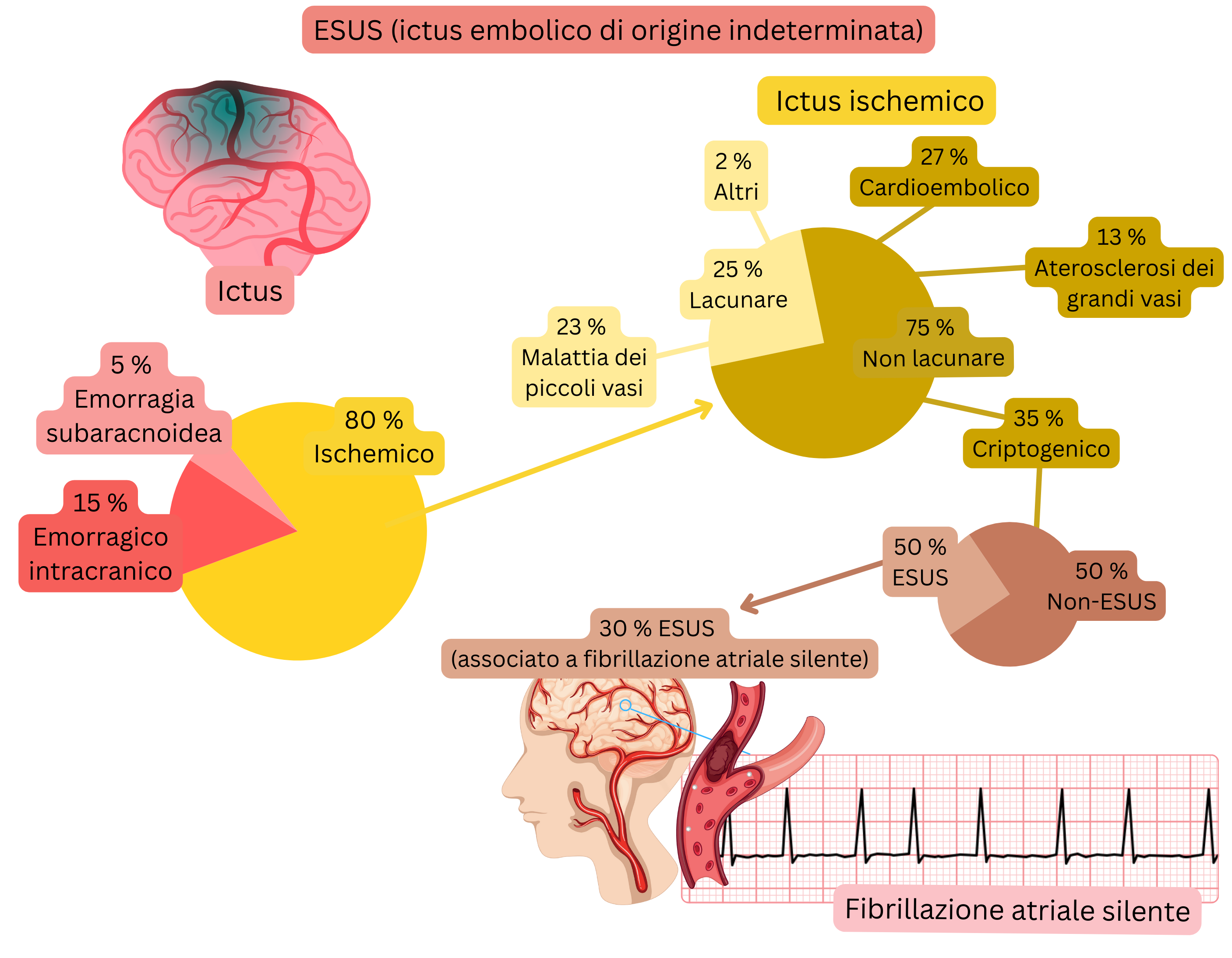 Infografica che illustra il concetto di ESUS nell’ictus ischemico, evidenziando la quota di eventi criptogenici e la relazione con la fibrillazione atriale silente come possibile fonte cardioembolica.