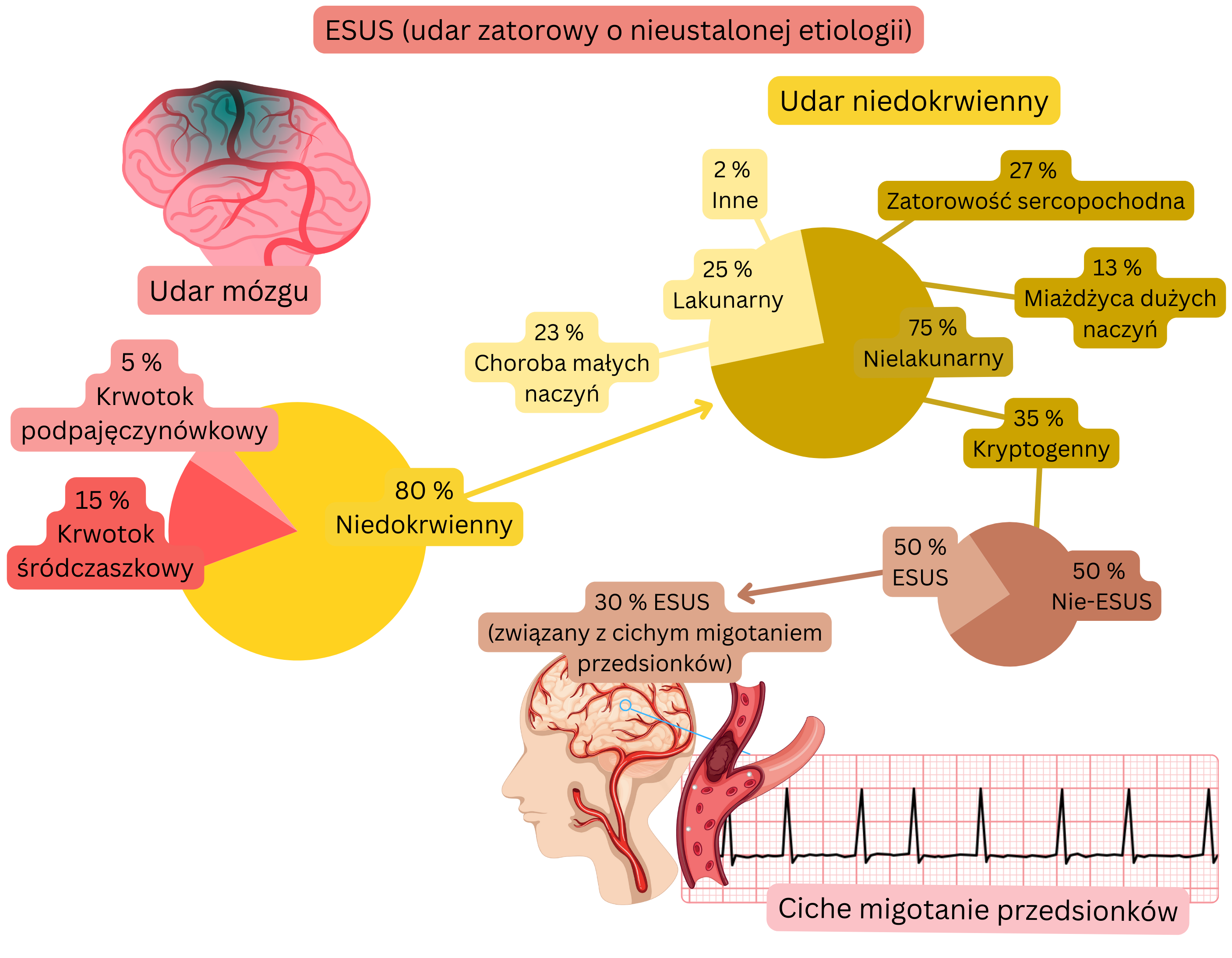 Infografika przedstawiająca koncepcję ESUS w udarze niedokrwiennym, z uwzględnieniem odsetka zdarzeń kryptogennych oraz związku z niemą postacią migotania przedsionków jako potencjalnym źródłem kardioembolii.