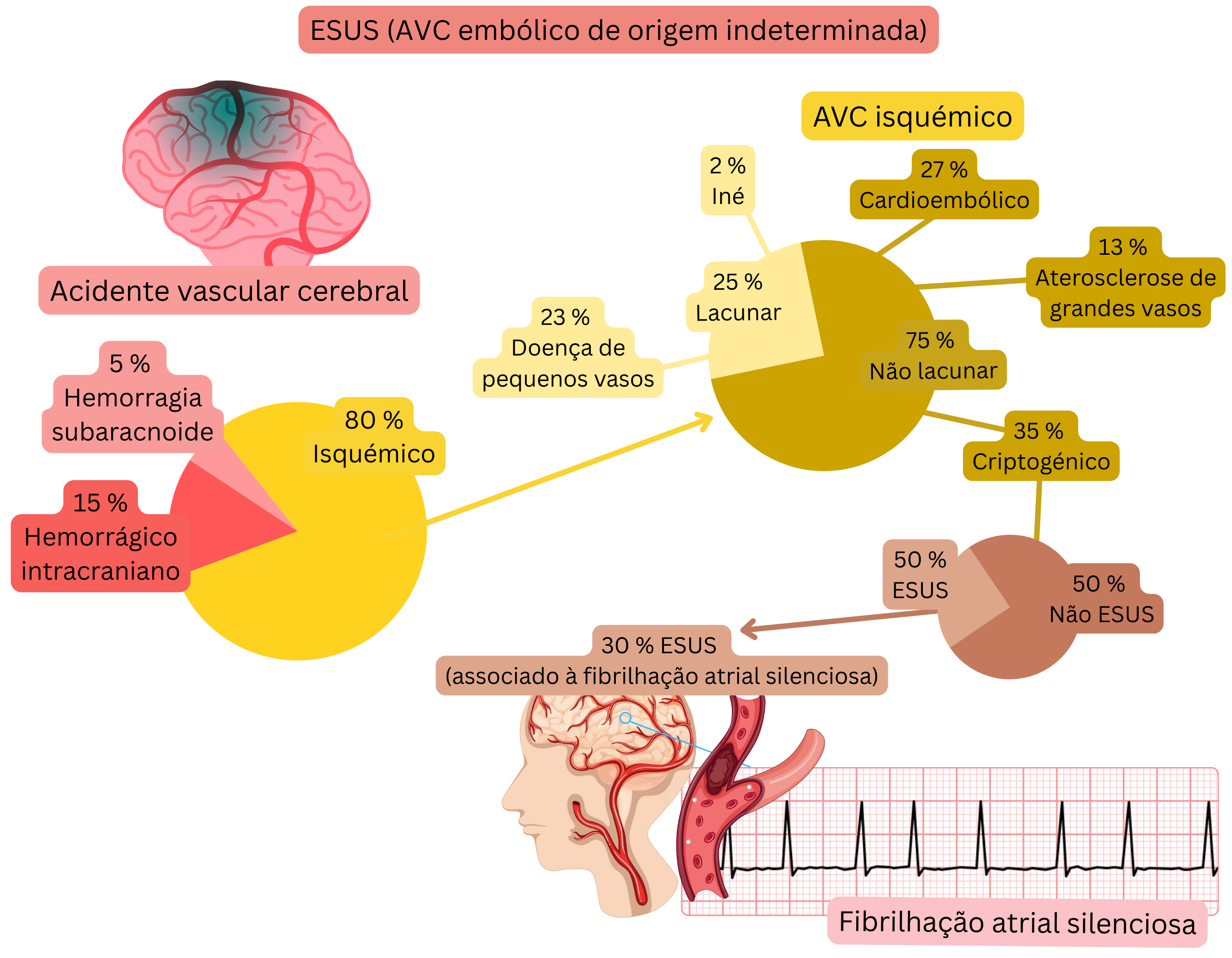 Infográfico que demonstra o conceito de ESUS no AVC isquémico, destacando a proporção de eventos criptogénicos e a relação com a fibrilação atrial silenciosa como possível fonte cardioembólica.