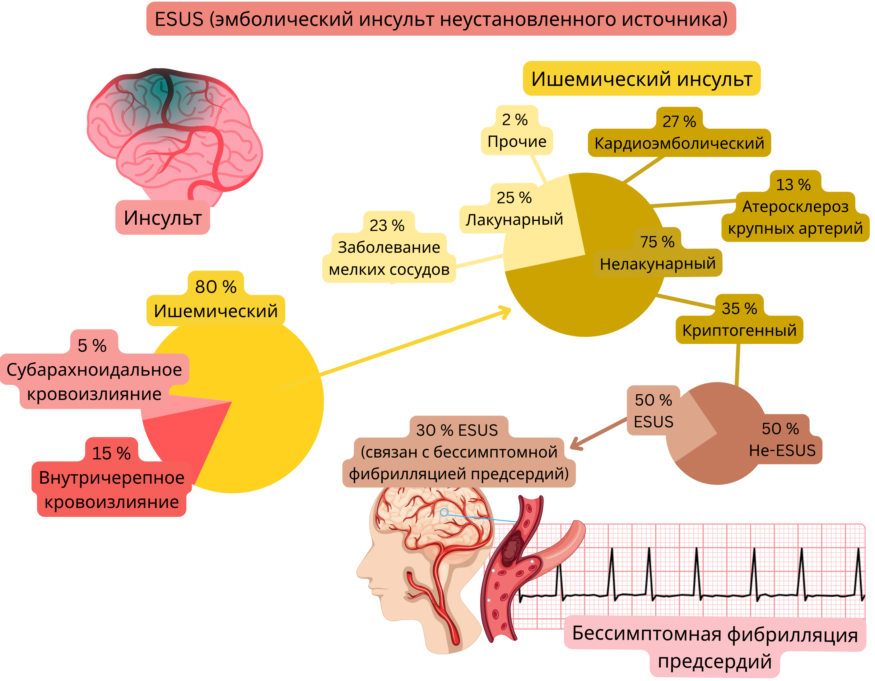 Инфографика, иллюстрирующая концепцию ESUS при ишемическом инсульте, с указанием доли криптогенных событий и связи с немой фибрилляцией предсердий как возможным кардиоэмболическим источником.