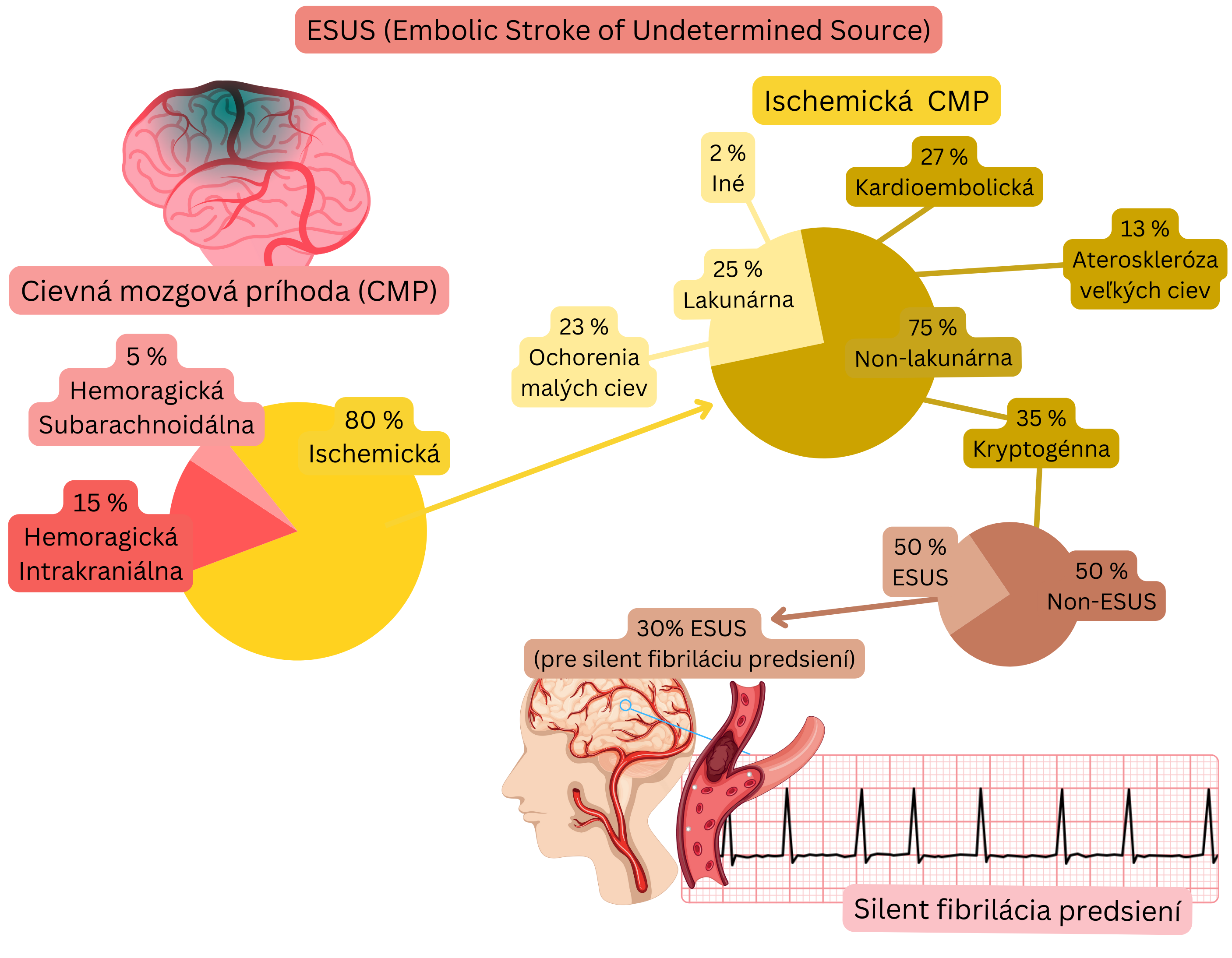Infografika znázorňujúca koncept ESUS v rámci ischemickej cievnej mozgovej príhody s podielom kryptogénnych príhod a vzťahom k tichej fibrilácii predsiení ako možnému kardioembolickému zdroju.