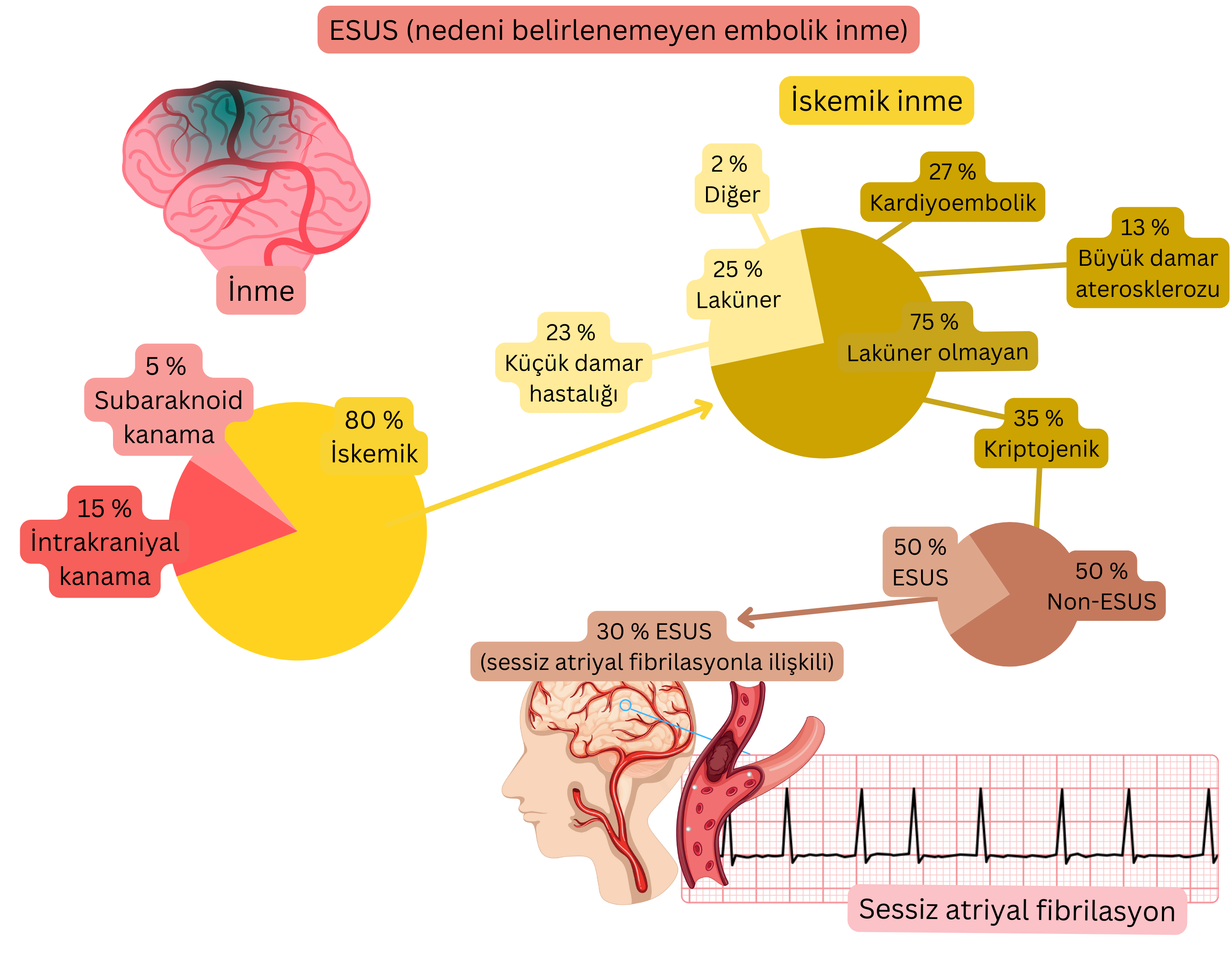 İskemik inmede ESUS kavramını gösteren, kriptojenik olayların oranını ve olası kardiyoembolik kaynak olarak sessiz atriyal fibrilasyon ile ilişkisini vurgulayan infografik.