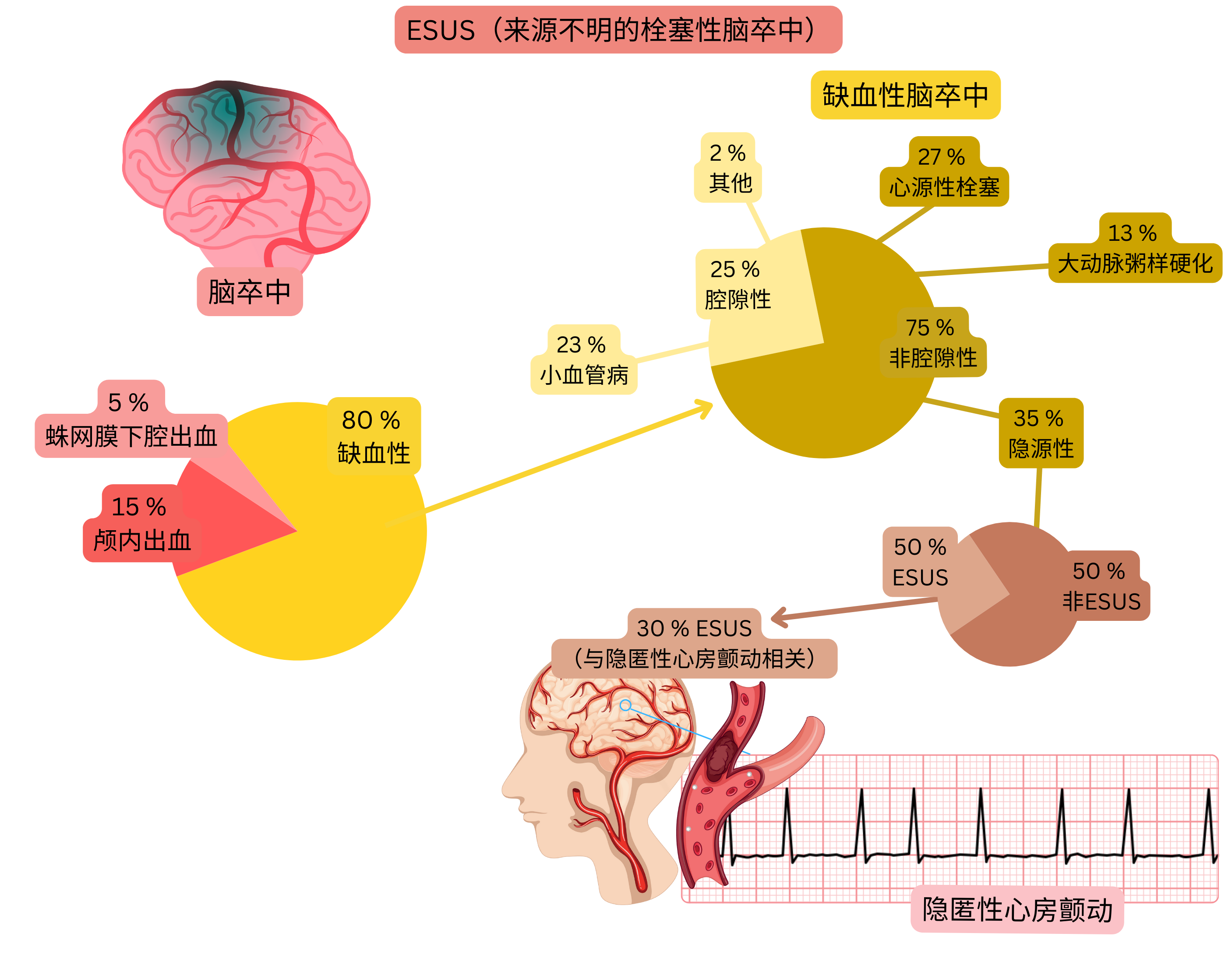 信息图展示缺血性脑卒中中的 ESUS 概念，强调隐源性事件的比例以及与隐匿性心房颤动作为潜在心源性栓塞来源之间的关系。