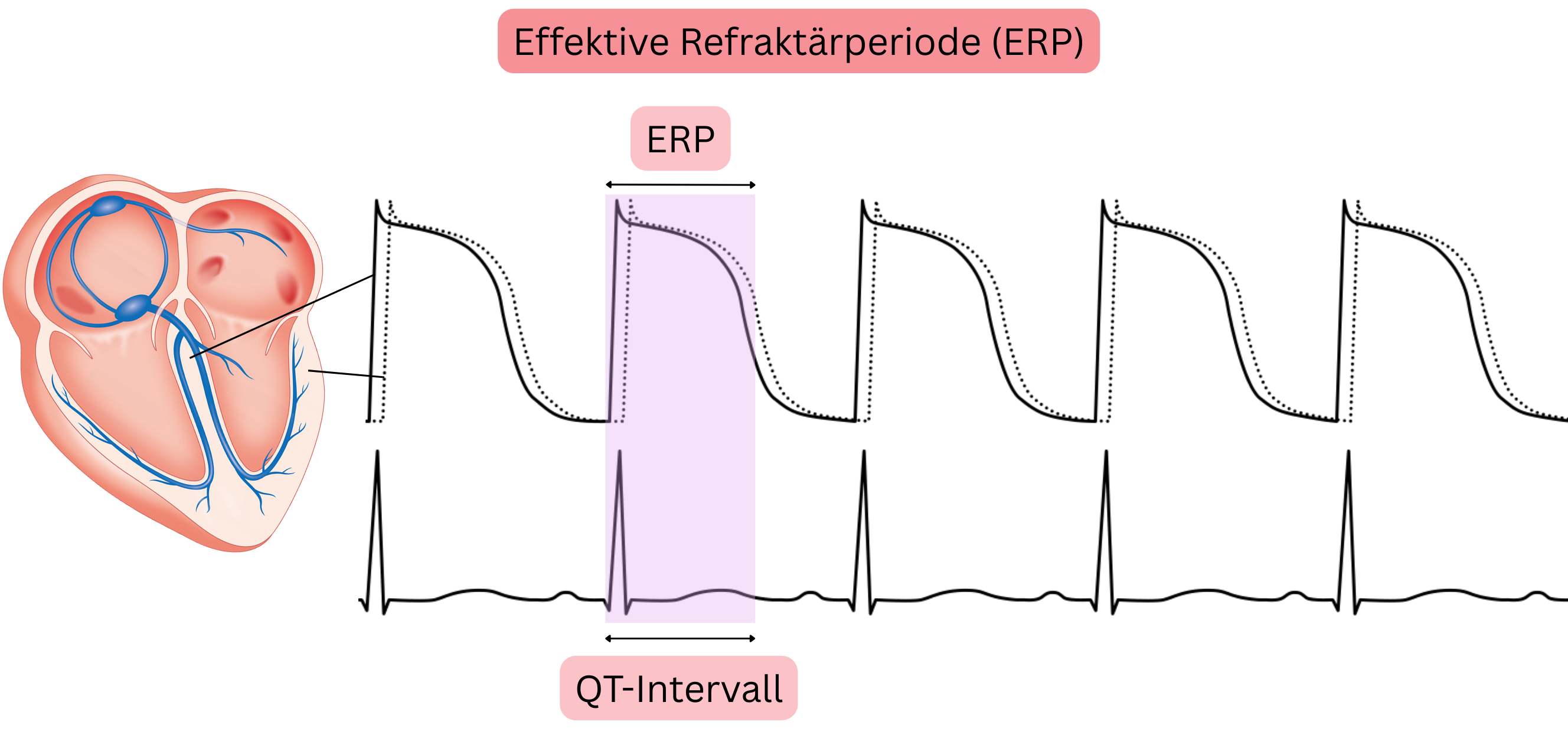 Schema der effektiven Refraktärperiode des Myokards mit Darstellung des Zusammenhangs zwischen Aktionspotenzial, effektiver Refraktärperiode und QT-Intervall im EKG.