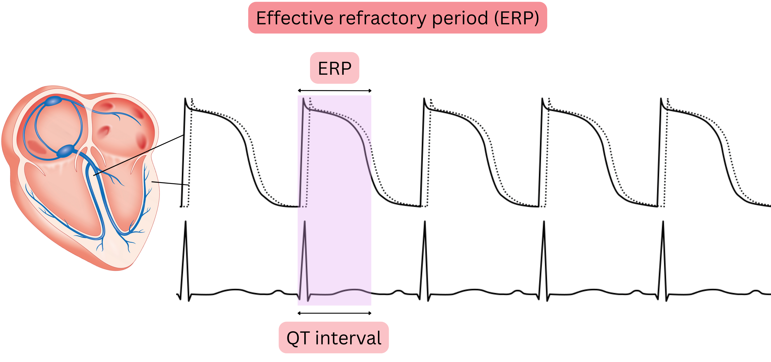Diagram of the myocardial effective refractory period illustrating the relationship between the action potential, the effective refractory period, and the QT interval on ECG.