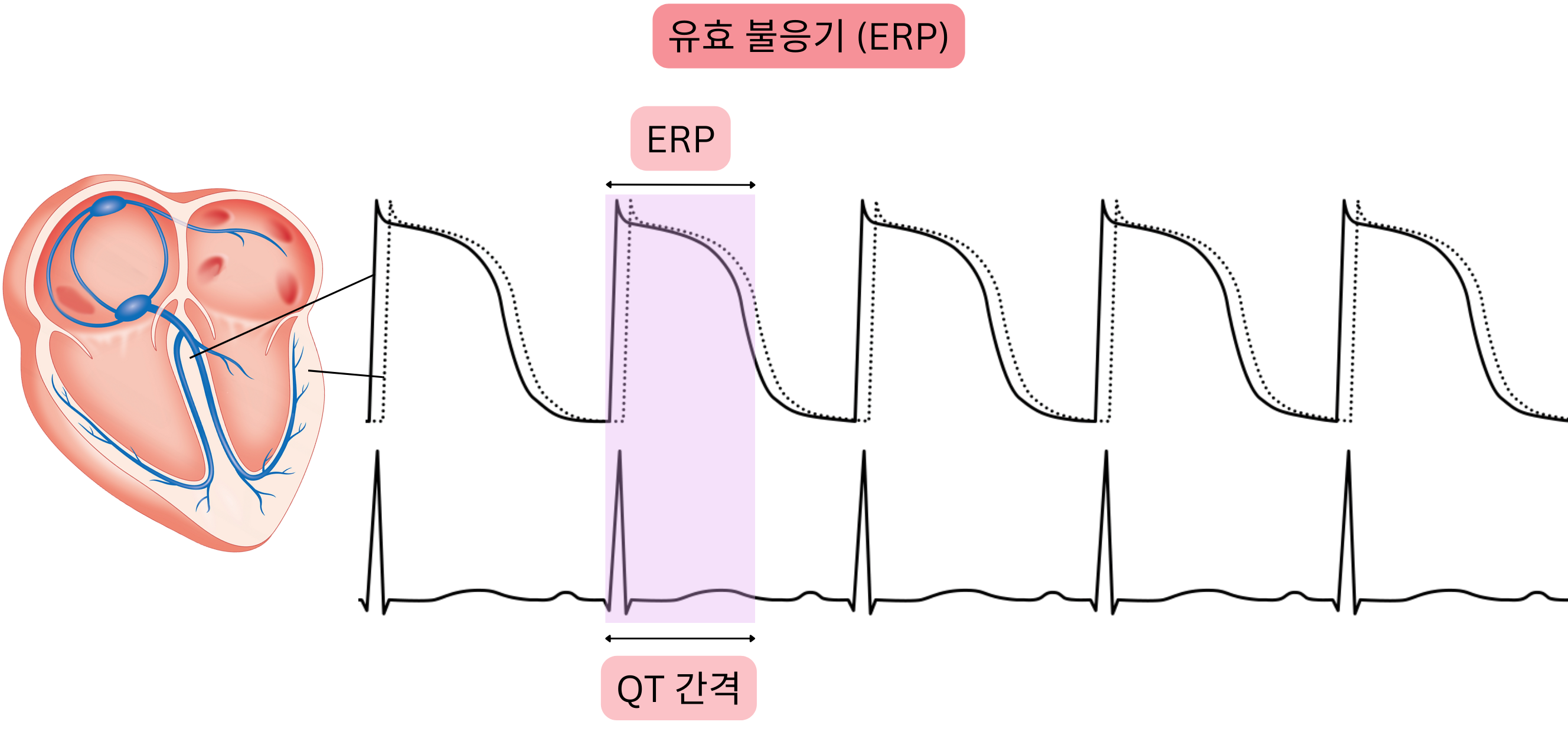 심근의 유효 불응기를 나타낸 도식으로, 활동전위, 유효 불응기 및 심전도에서 QT 간격 간의 관계를 보여준다.