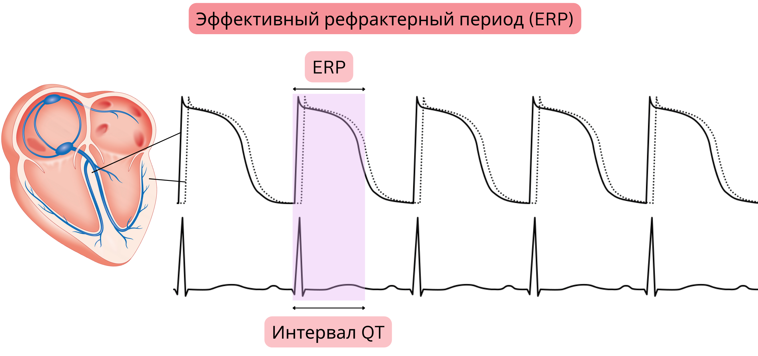 Схема эффективного рефрактерного периода миокарда, показывающая взаимосвязь между потенциалом действия, эффективным рефрактерным периодом и интервалом QT на ЭКГ.