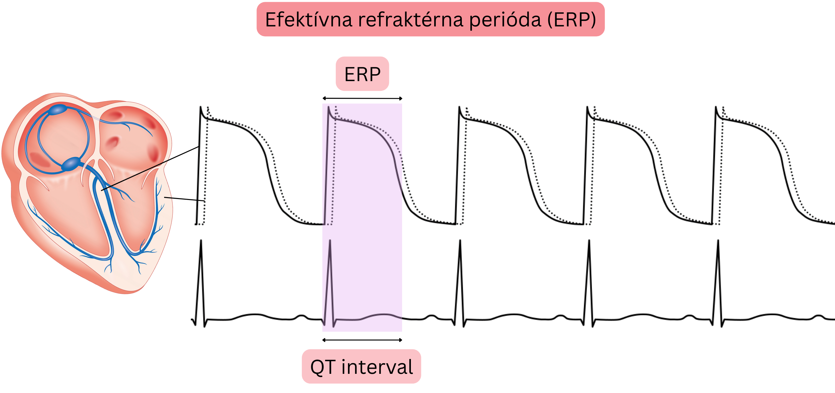 Schéma efektívnej refraktérnej periódy myokardu znázorňujúca vzťah medzi akčným potenciálom, efektívnou refraktérnou periódou a QT intervalom na EKG.