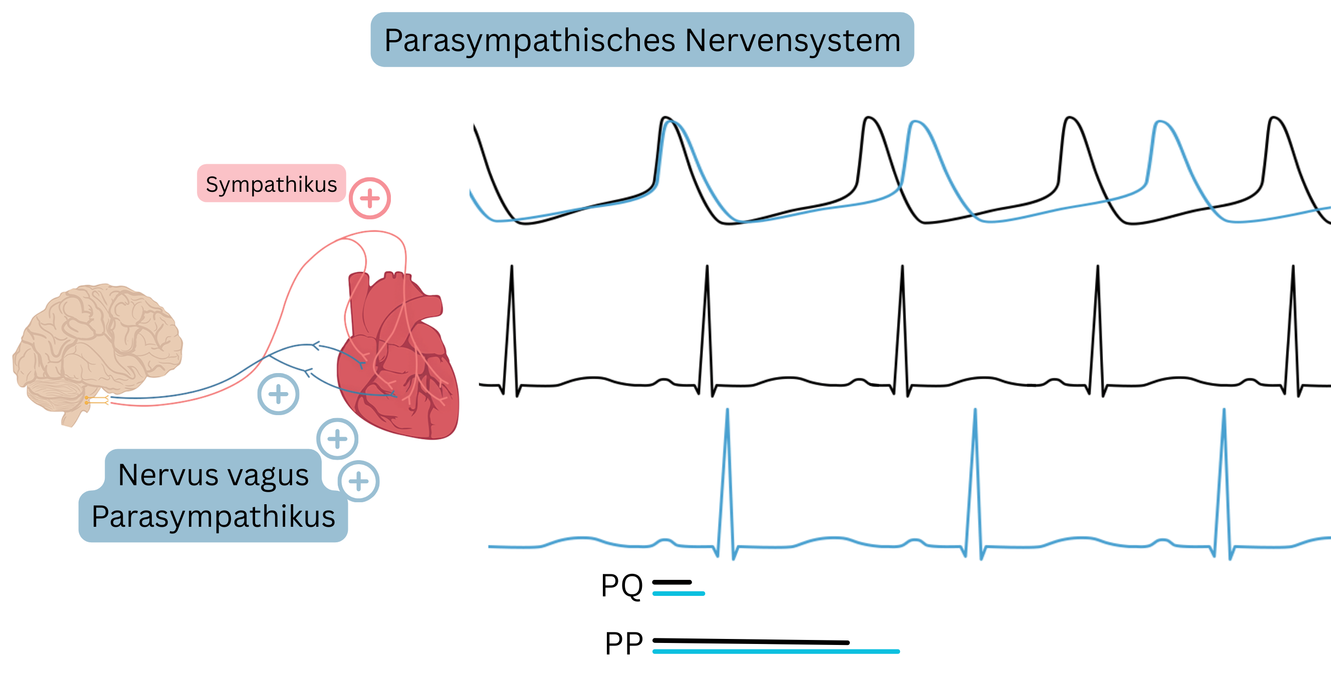 Schema der parasympathischen Dominanz mit Darstellung einer erhöhten Aktivität des Nervus vagus, Abnahme der Herzfrequenz und Verlängerung der PP- und PQ-Intervalle im EKG.