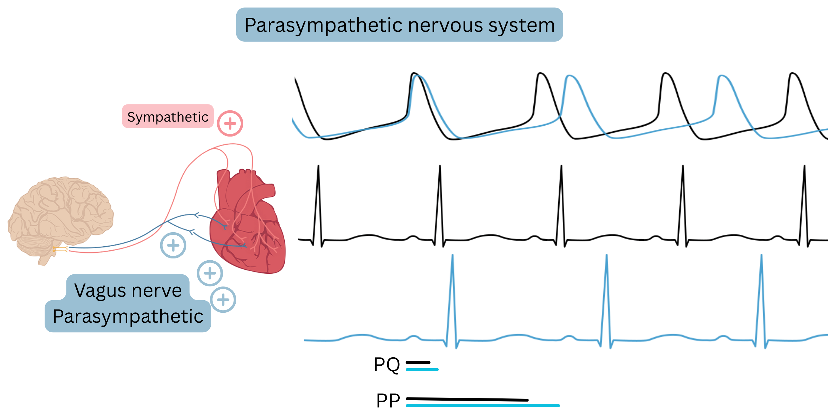Diagram of parasympathetic predominance illustrating increased vagal nerve activity with reduced heart rate and prolongation of the PP and PQ intervals on ECG.