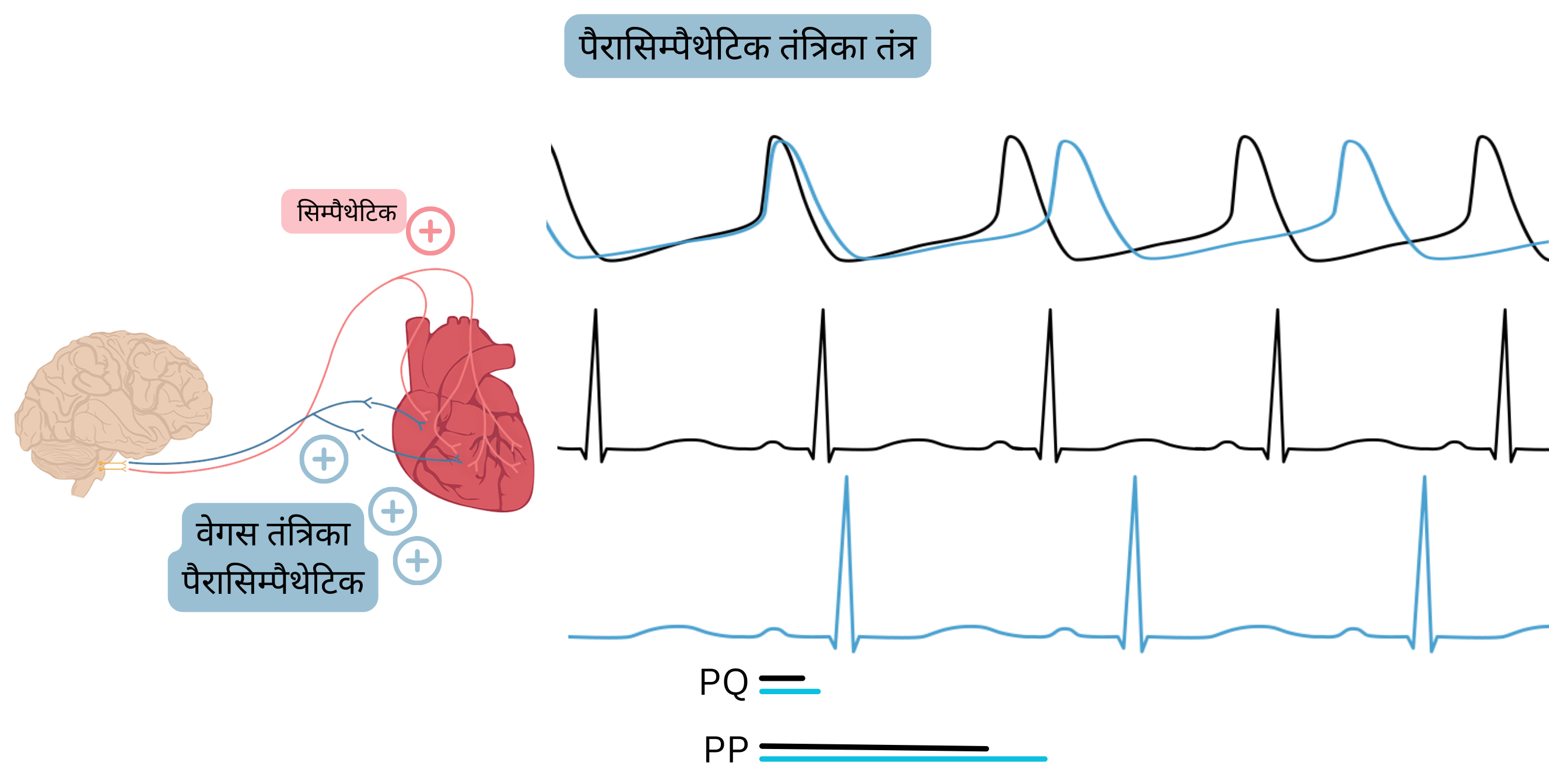 पैरासिम्पैथेटिक प्रभुत्व का आरेख, जिसमें वेगस तंत्रिका की बढ़ी हुई सक्रियता के कारण हृदय गति में कमी और ईसीजी पर PP तथा PQ अंतराल के बढ़ने को दर्शाया गया है।