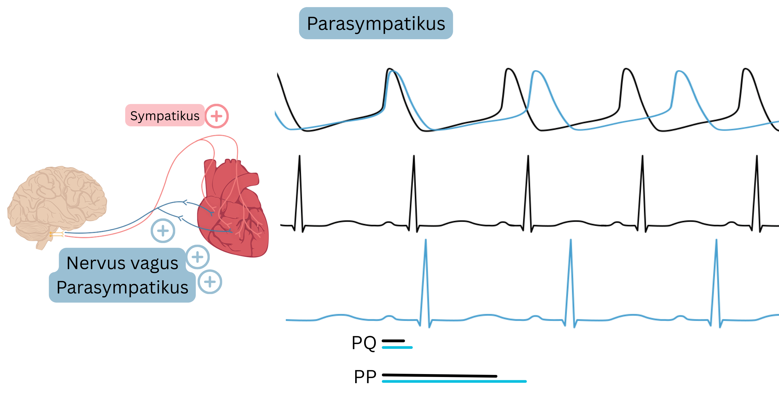 Schéma prevahy parasympatika znázorňujúca zvýšenú aktivitu nervus vagus s poklesom srdcovej frekvencie a predĺžením PP a PQ intervalu na EKG.